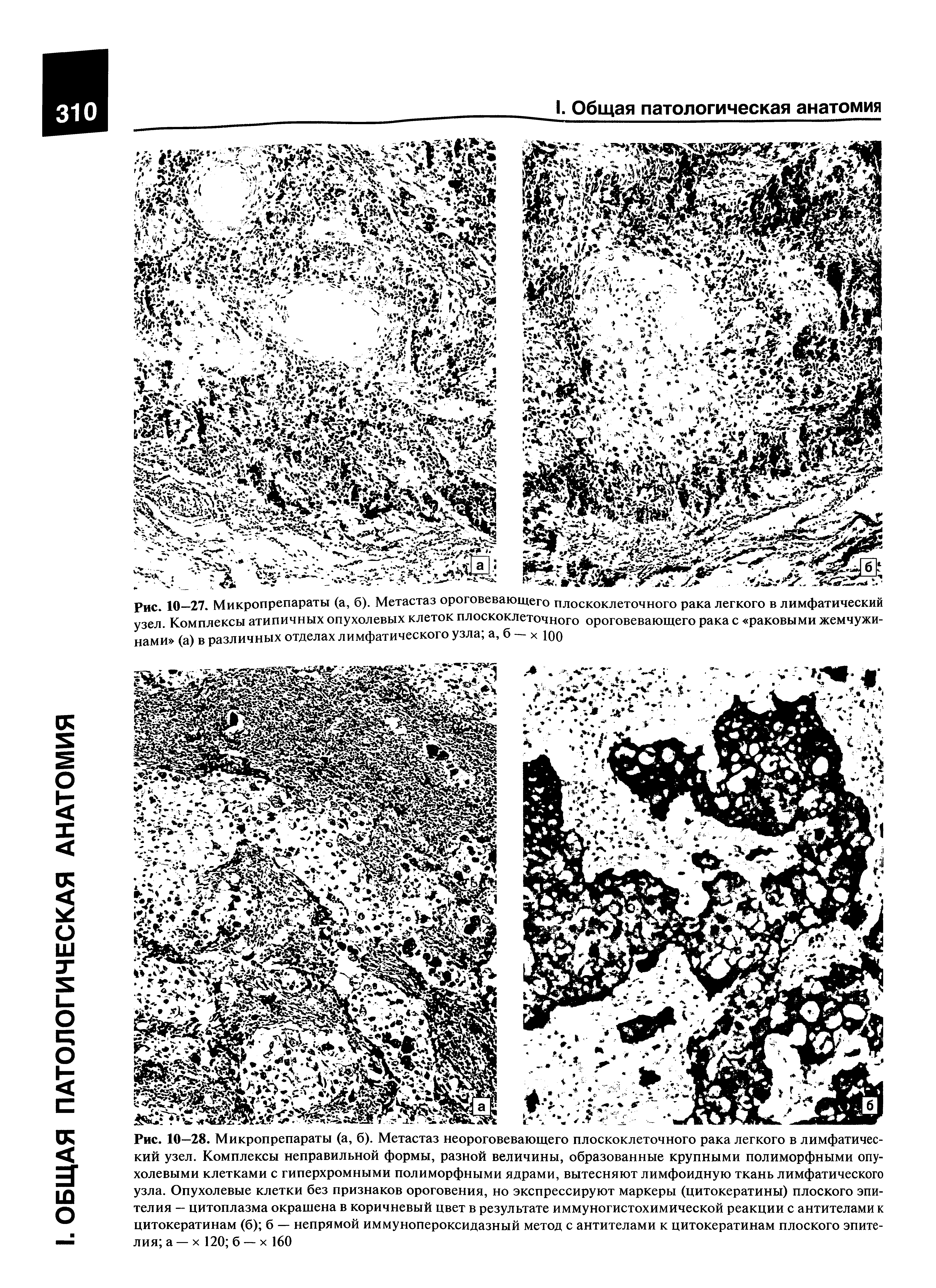 Рис. 10—27. Микропрепараты (а, б). Метастаз ороговевающего плоскоклеточного рака легкого в лимфатический узел. Комплексы атипичных опухолевых клеток плоскоклеточного ороговевающего рака с раковыми жемчужинами (а) в различных отделах лимфатического узла а, б — х 100...