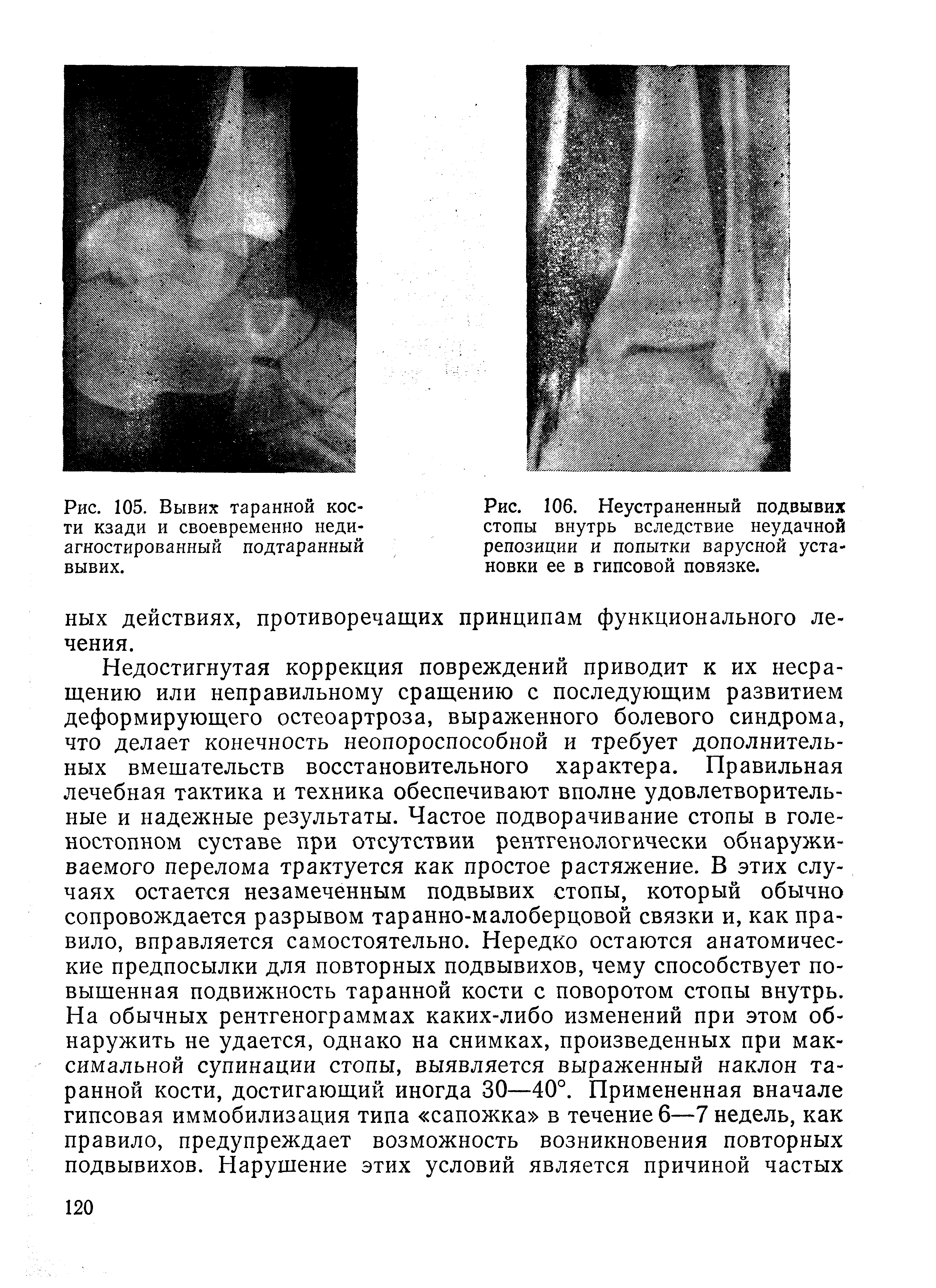 Рис. 105. Вывих таранной кости кзади и своевременно неди-агностированный подтаранный вывих.