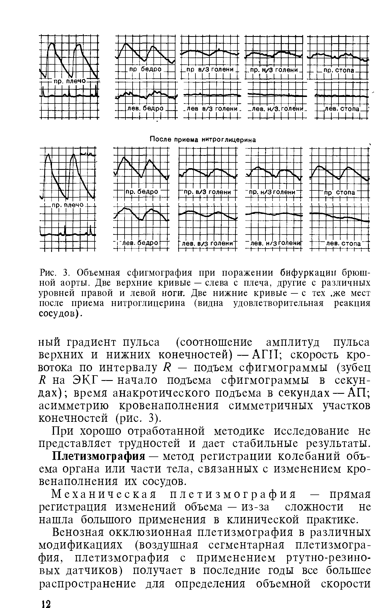 Рис. 3. Объемная сфигмография при поражении бифуркации брюшной аорты. Две верхние кривые — слева с плеча, другие с различных уровней правой и левой ногиг. Две нижние кривые — с тех. же мест после приема нитроглицерина (видна удовлетворительная реакция сосудов).