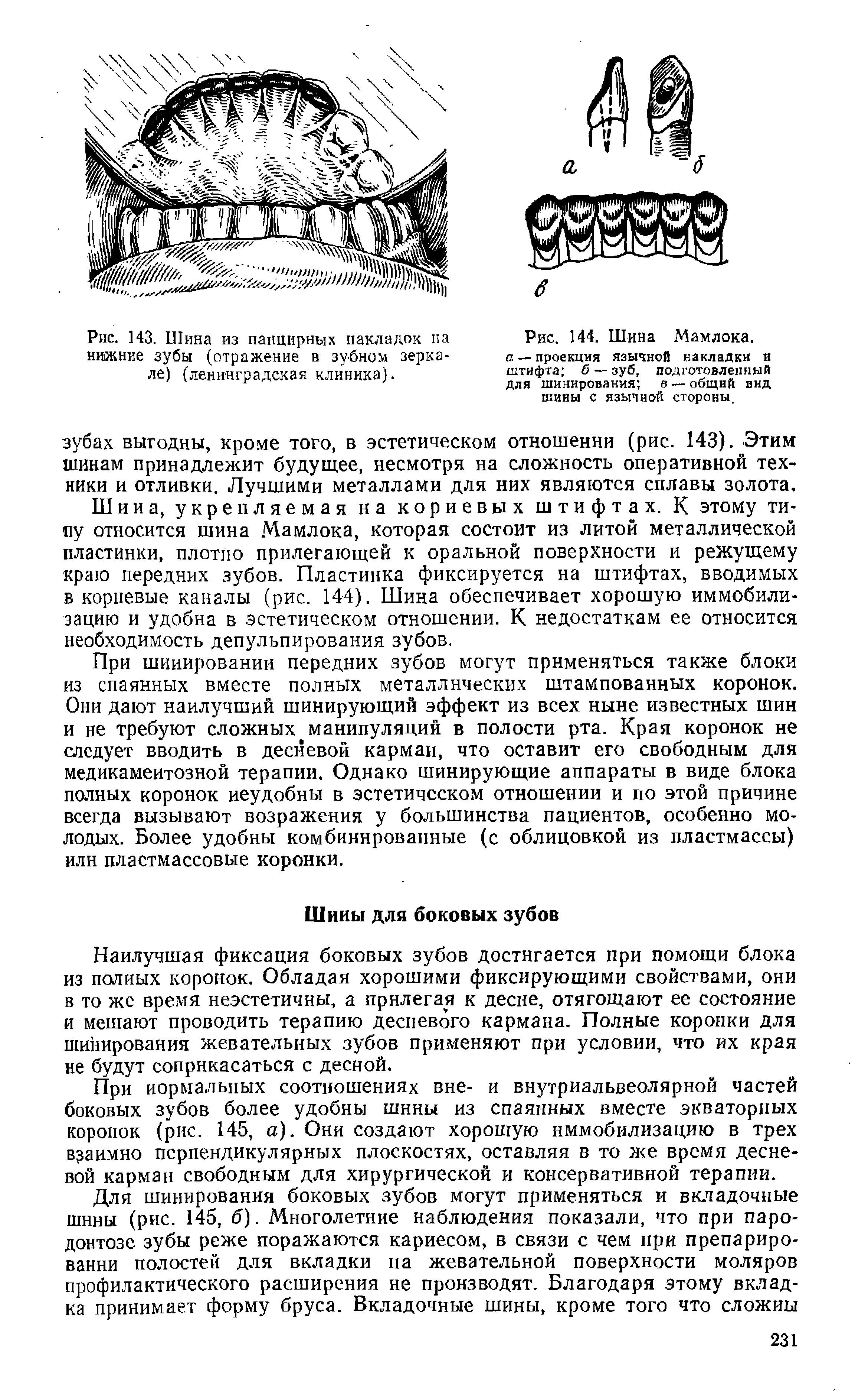 Рис. 144. Шина Мамлока. а — проекция язычной накладки и штифта б — зуб, подготовленный для шинирования в — общий вид шины с язычной стороны.