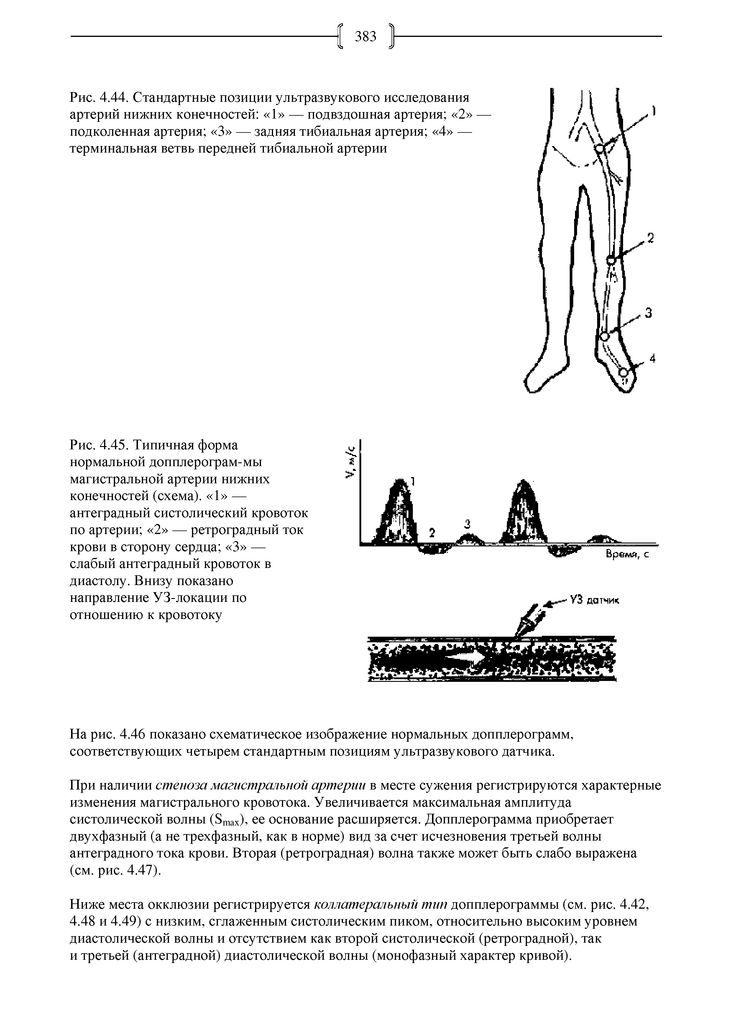 Рис. 4.45. Типичная форма нормальной допплерограм-мы магистральной артерии нижних конечностей (схема). 1 — антеградный систолический кровоток по артерии 2 — ретроградный ток крови в сторону сердца 3 — слабый антеградный кровоток в диастолу. Внизу показано направление УЗ-локации по отношению к кровотоку...