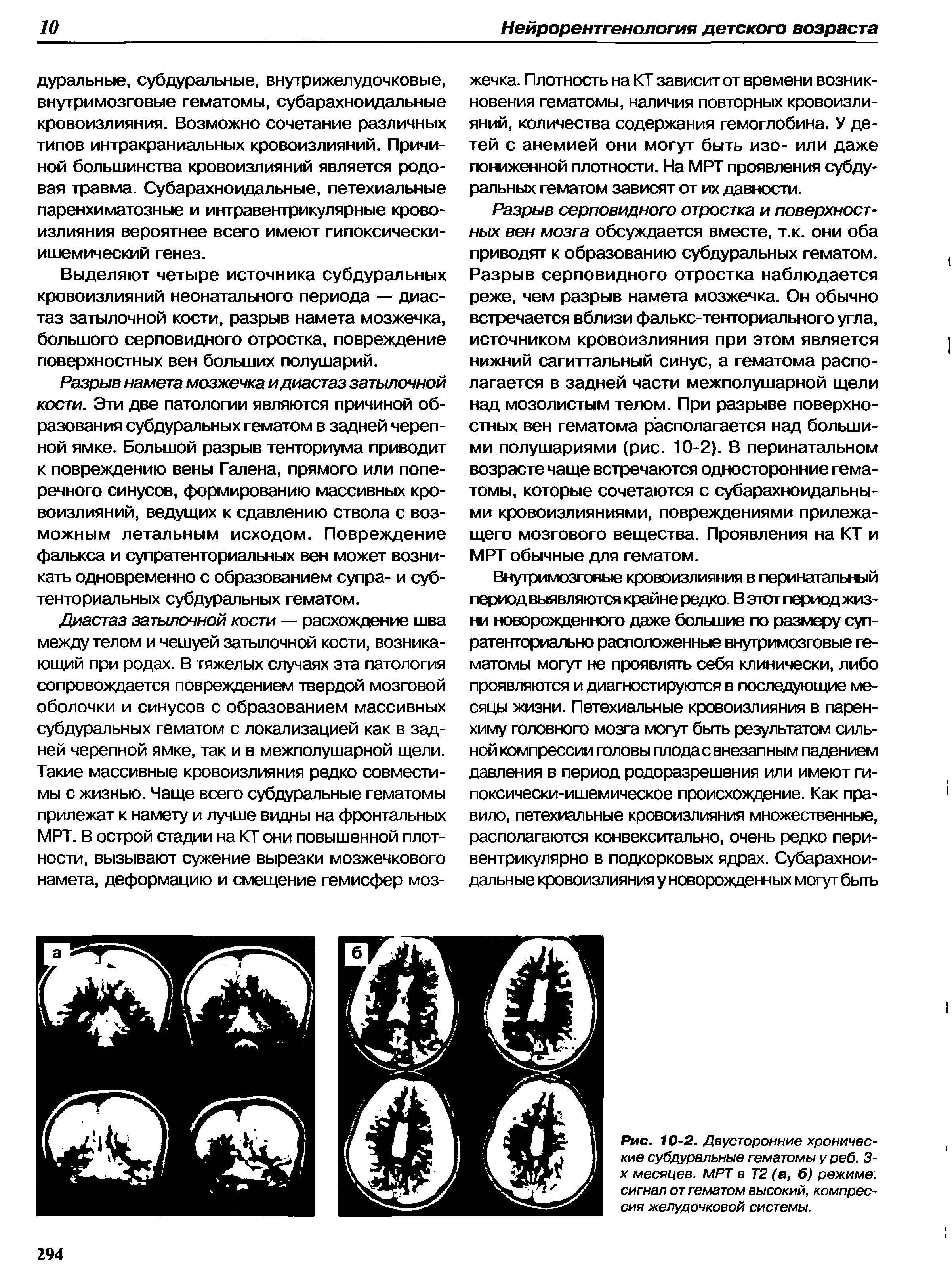 Рис. 10-2. Двусторонние хронические субдуральные гематомы у реб. 3-х месяцев. МРТ в T2 (а, б) режиме, сигнал от гематом высокий, компрессия желудочковой системы.