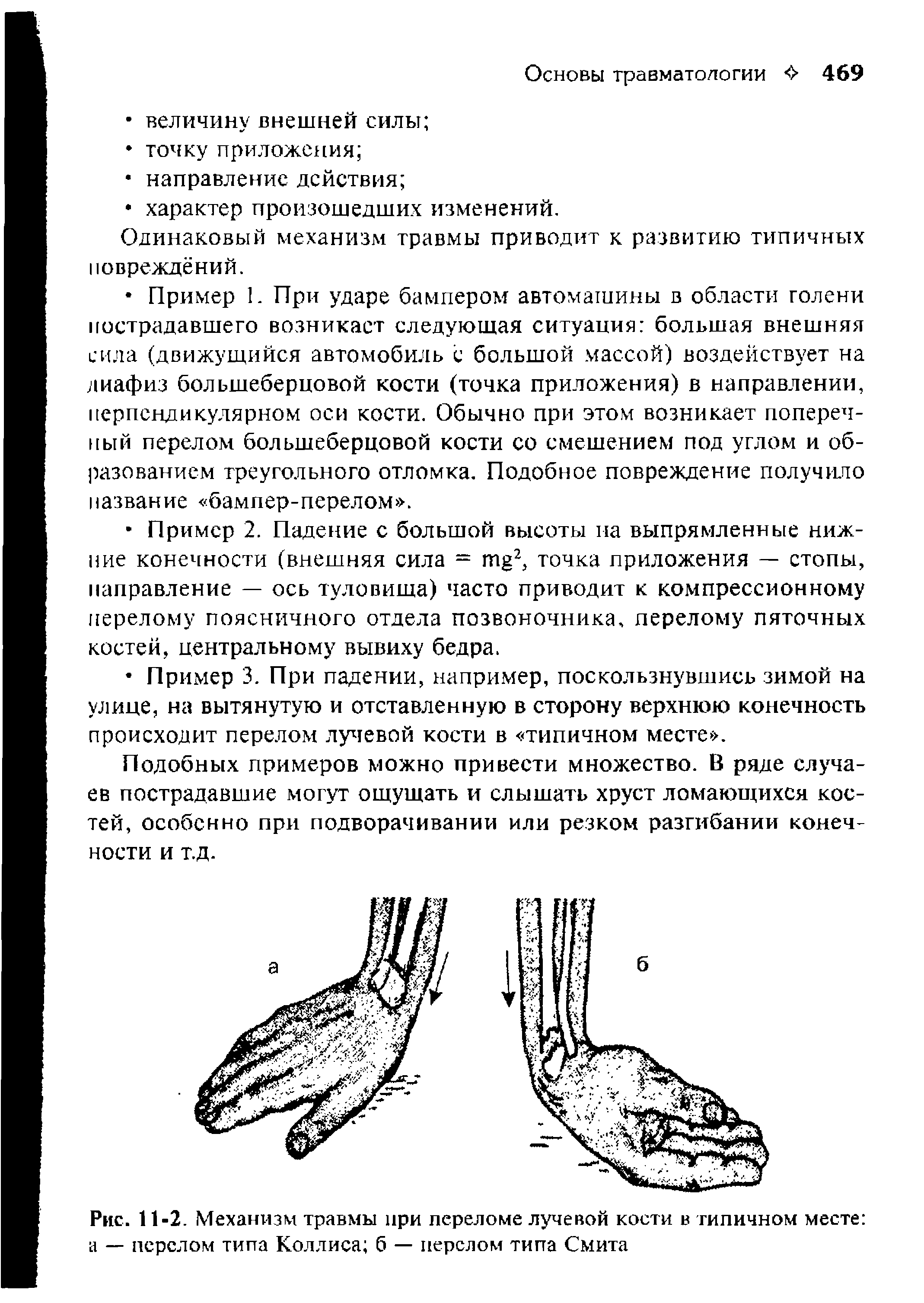 Рис. 11-2. Механизм травмы при переломе лучевой кости в типичном месте а — перелом типа Коллиса б — перелом типа Смита...