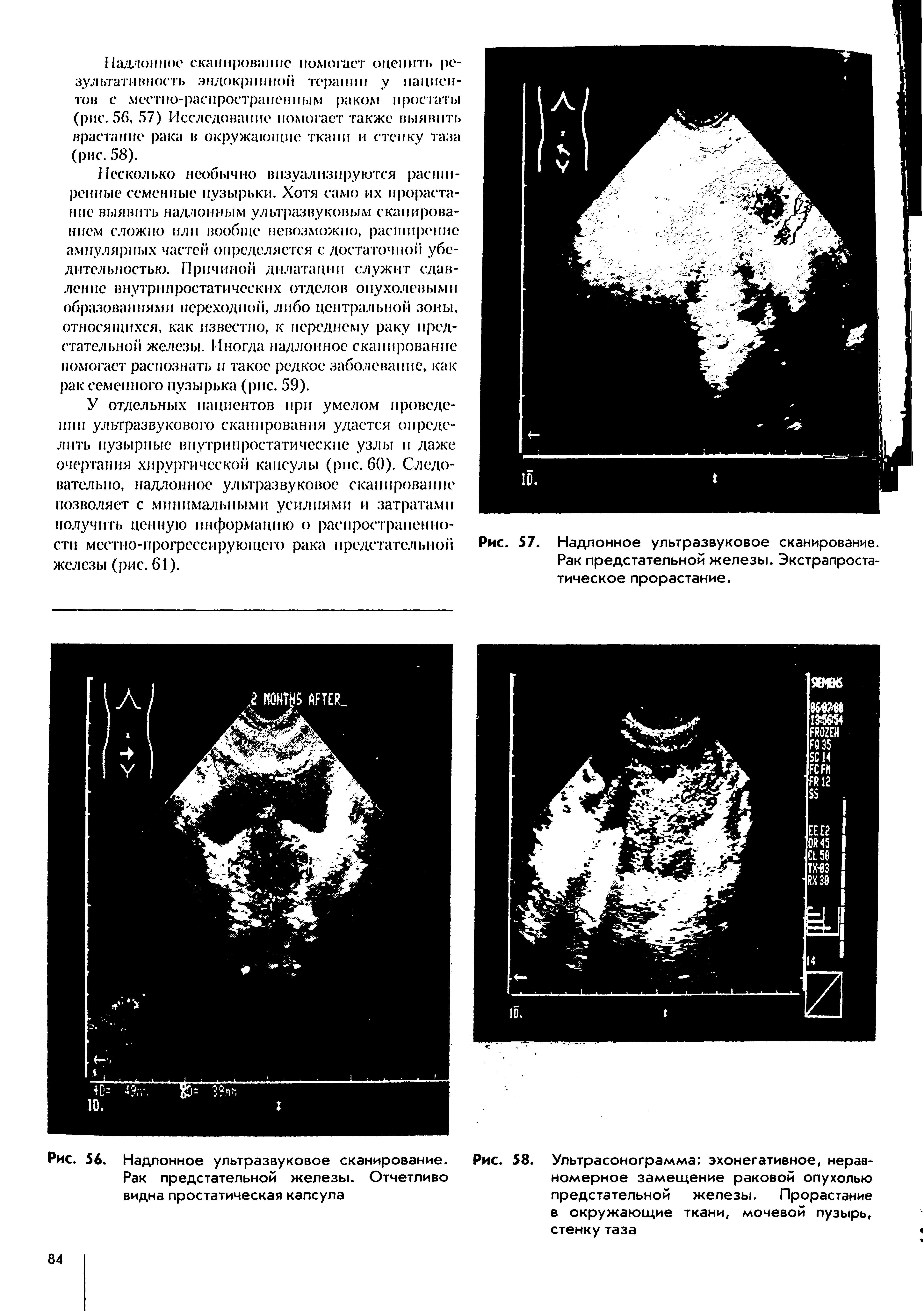 Рис. 58. Ультрасонограмма эхонегативное, неравномерное замещение раковой опухолью предстательной железы. Прорастание в окружающие ткани, мочевой пузырь, стенку таза...