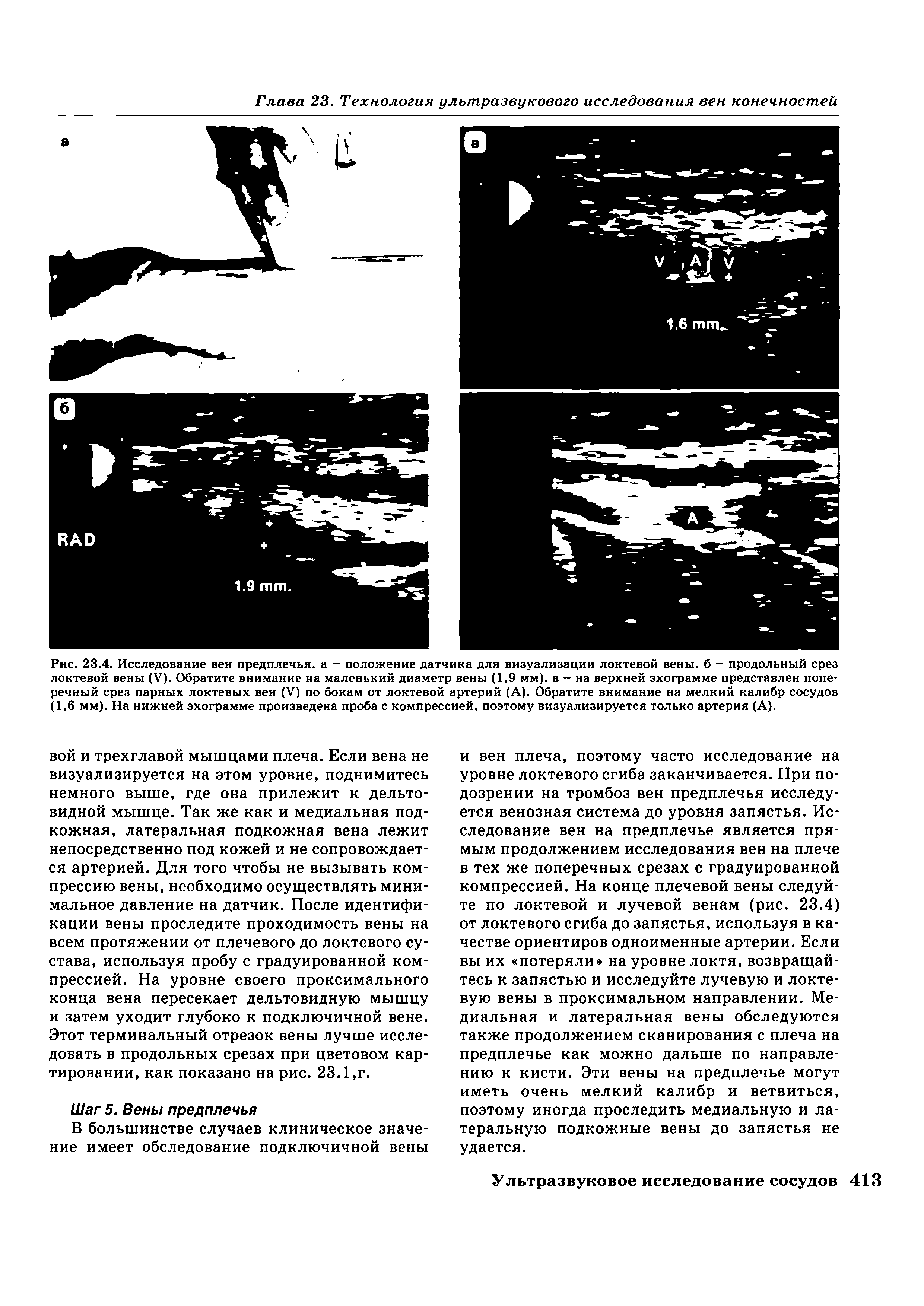 Рис. 23.4. Исследование вен предплечья, а - положение датчика для визуализации локтевой вены, б - продольный срез локтевой вены (V). Обратите внимание на маленький диаметр вены (1,9 мм), в - на верхней эхограмме представлен поперечный срез парных локтевых вен (V) по бокам от локтевой артерий (А). Обратите внимание на мелкий калибр сосудов (1,6 мм). На нижней эхограмме произведена проба с компрессией, поэтому визуализируется только артерия (А).