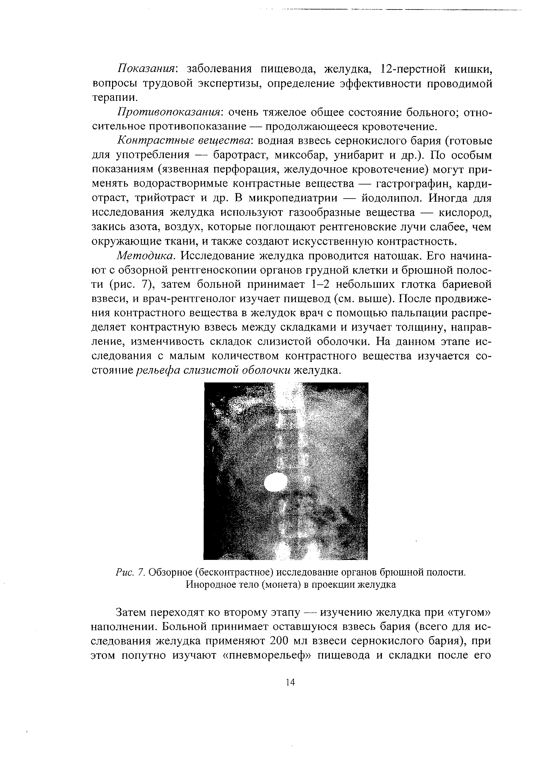 Рис. 7. Обзорное (бесконтрастное) исследование органов брюшной полости. Инородное тело (монета) в проекции желудка...