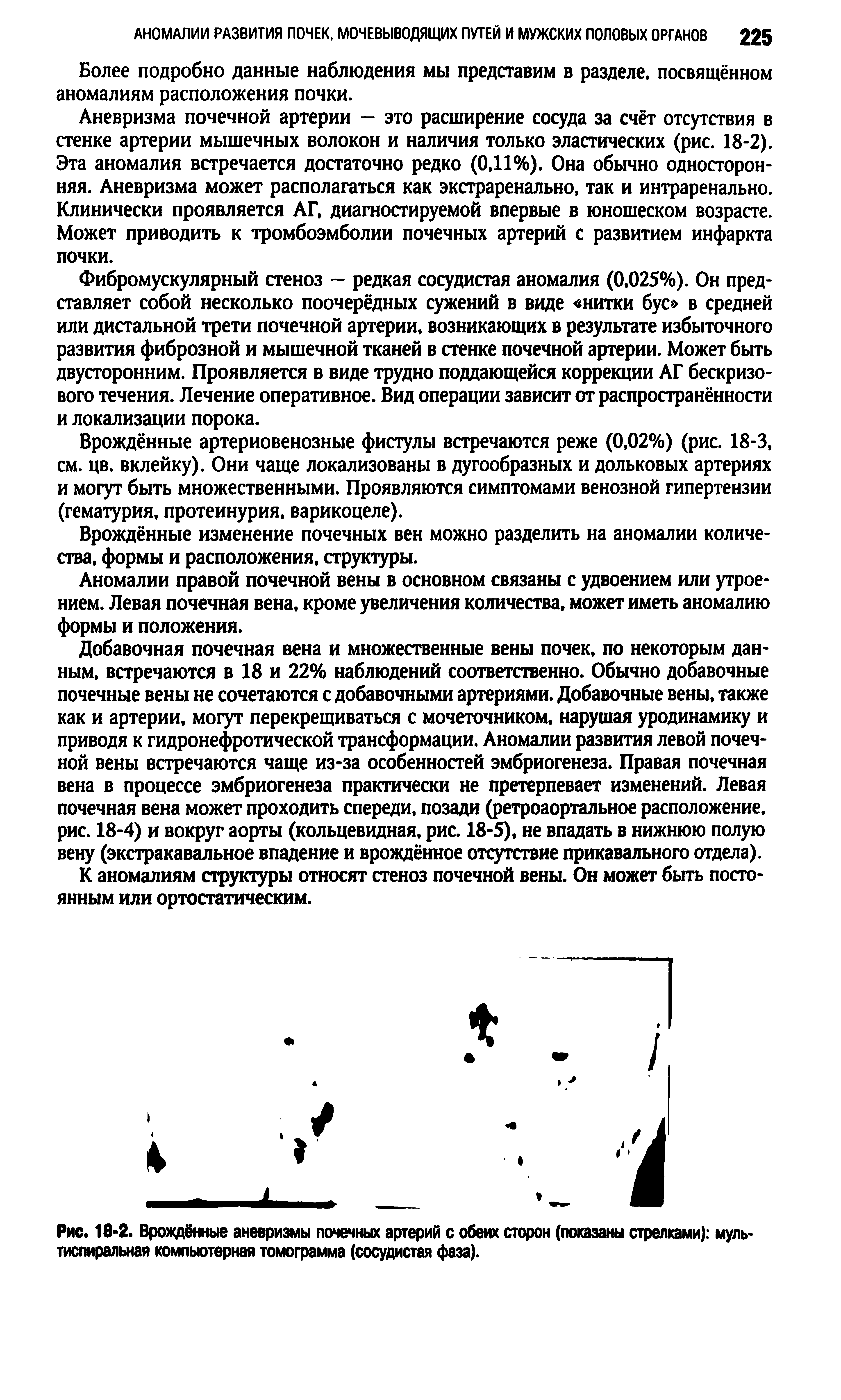 Рис. 18 2. Врождённые аневризмы почечных артерий с обеих сторон (показаны стрелками) муль-тиспиральная компьютерная томограмма (сосудистая фаза).