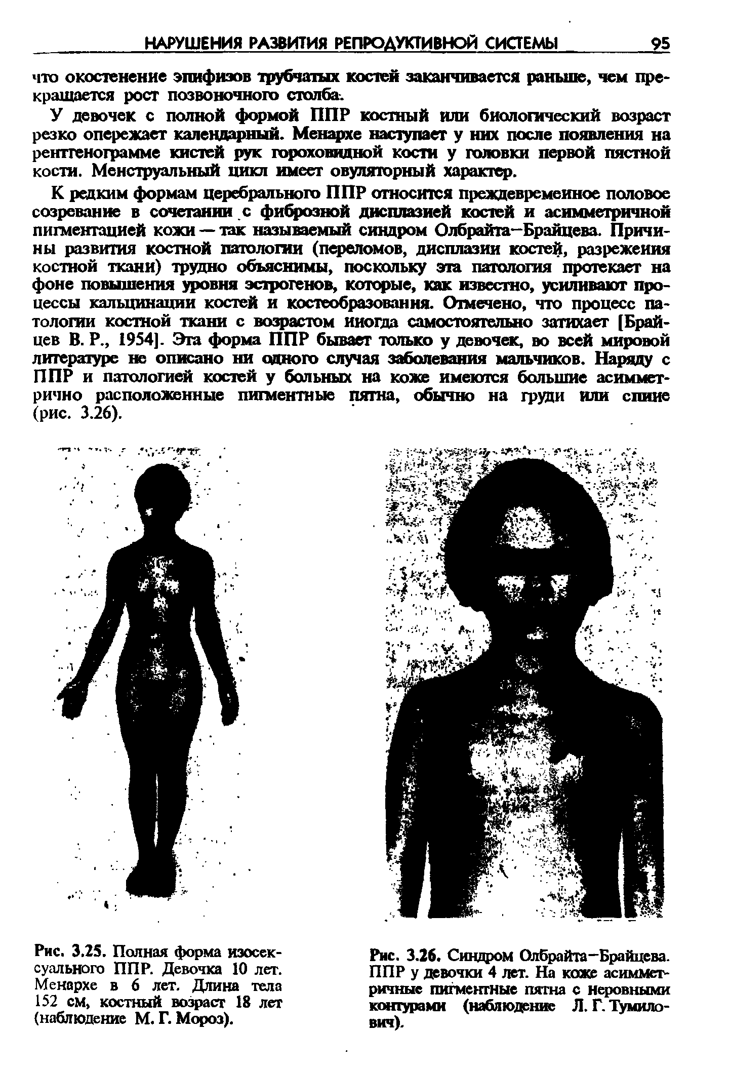 Рис. 3.26. Синдром Олбрайта-Брайцева. ППР у девочки 4 лет. На коже асимметричные пигментные пятна с неровными контурами (наблюдение Л. Г. Тумилович).