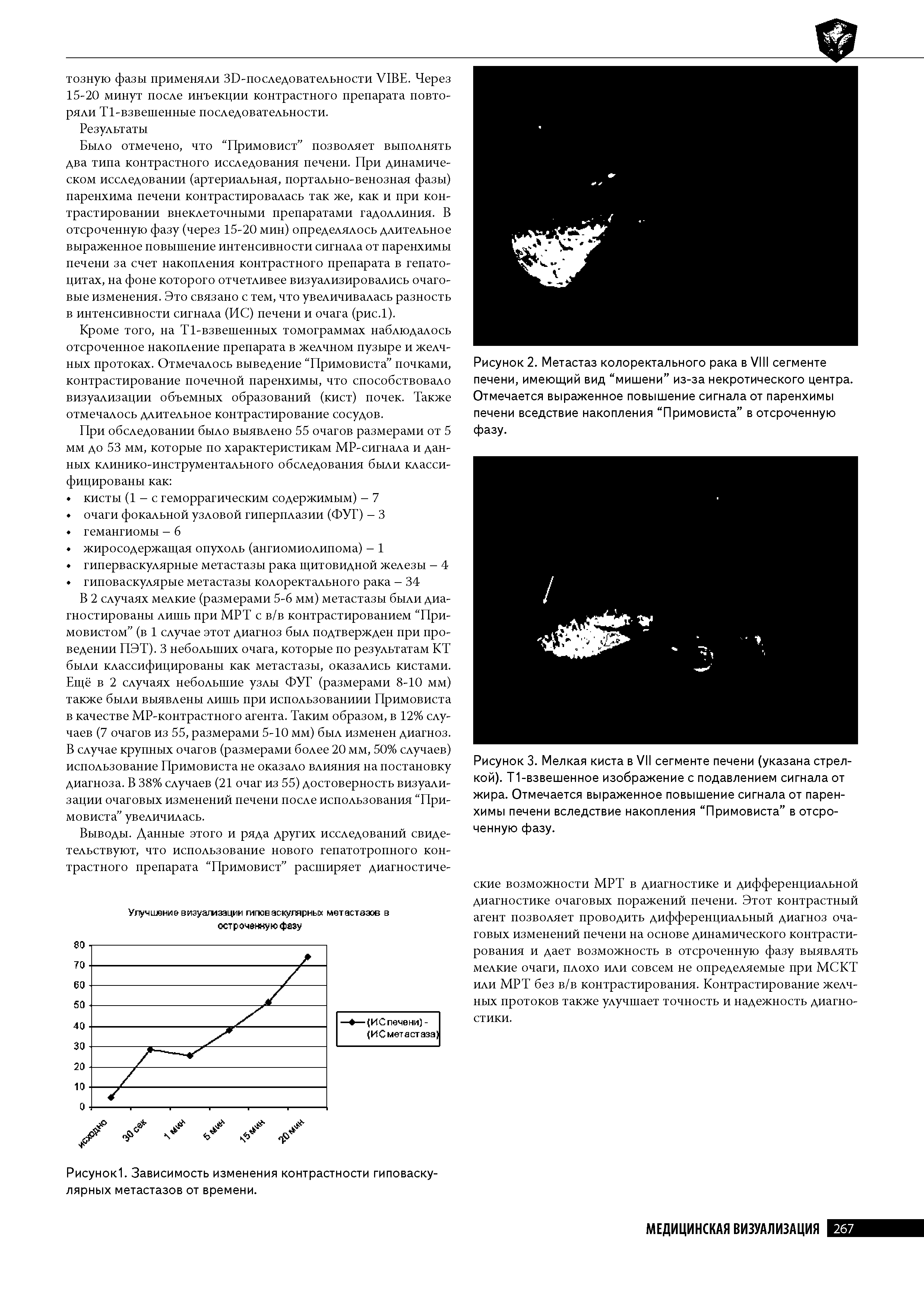 Рисунок 3. Мелкая киста в VII сегменте печени (указана стрелкой). Т1-взвешенное изображение с подавлением сигнала от жира. Отмечается выраженное повышение сигнала от паренхимы печени вследствие накопления Примовиста в отсроченную фазу.