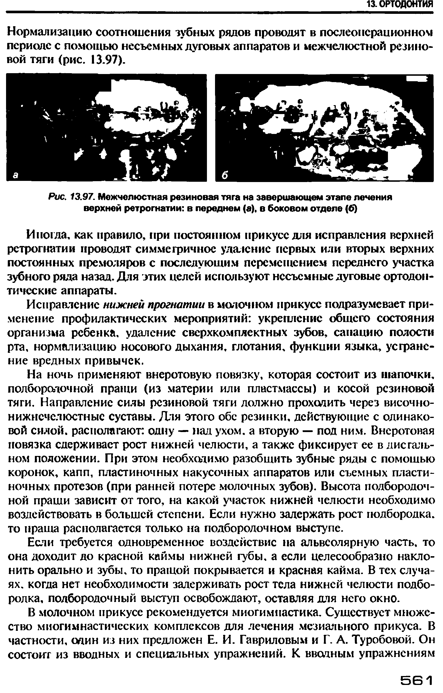 Рис. 13.97. Межчелюстная резиновая тяга на завершающем этапе лечения верхней ретрогнатии в переднем (а), в боковом отделе (б)...