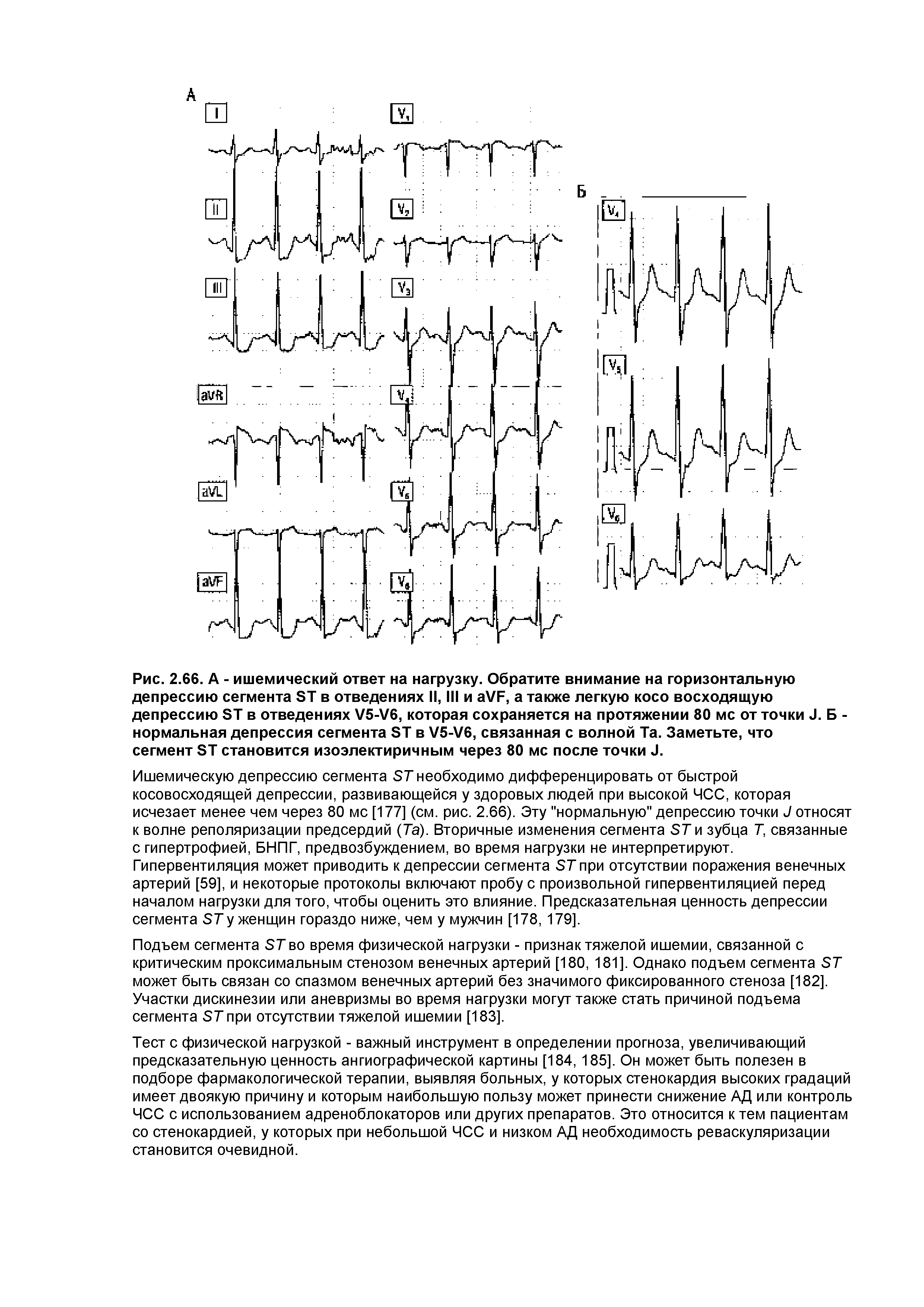 Рис. 2.66. А - ишемический ответ на нагрузку. Обратите внимание на горизонтальную депрессию сегмента ST в отведениях II, III и VF, а также легкую косо восходящую депрессию ST в отведениях V5-V6, которая сохраняется на протяжении 80 мс от точки J. Б -нормальная депрессия сегмента ST в V5-V6, связанная с волной Та. Заметьте, что сегмент ST становится изоэлектиричным через 80 мс после точки J.