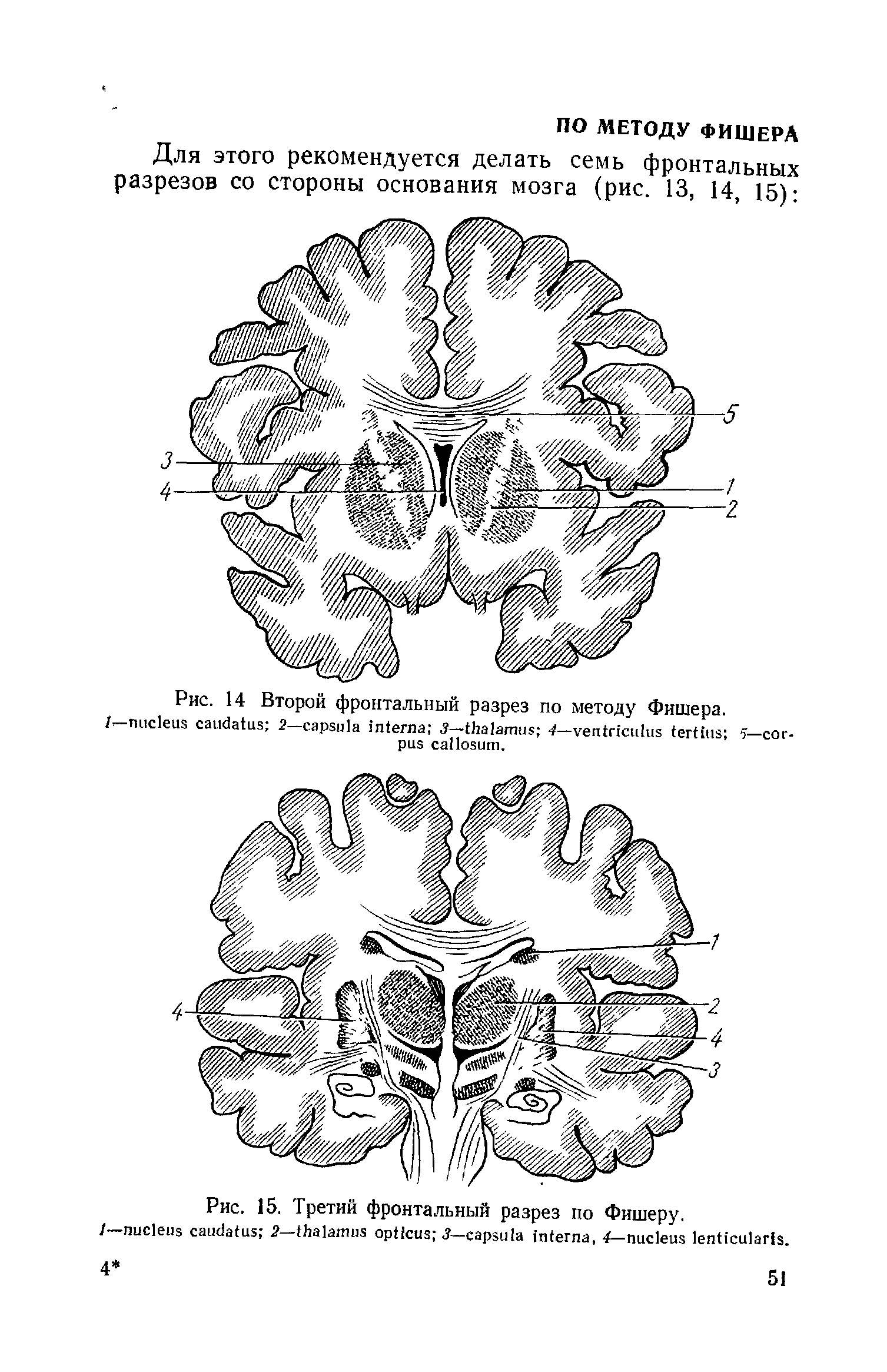 Рис. 14 Второй фронтальный разрез по методу Фишера, /-- 2— 3— 4— 5— .