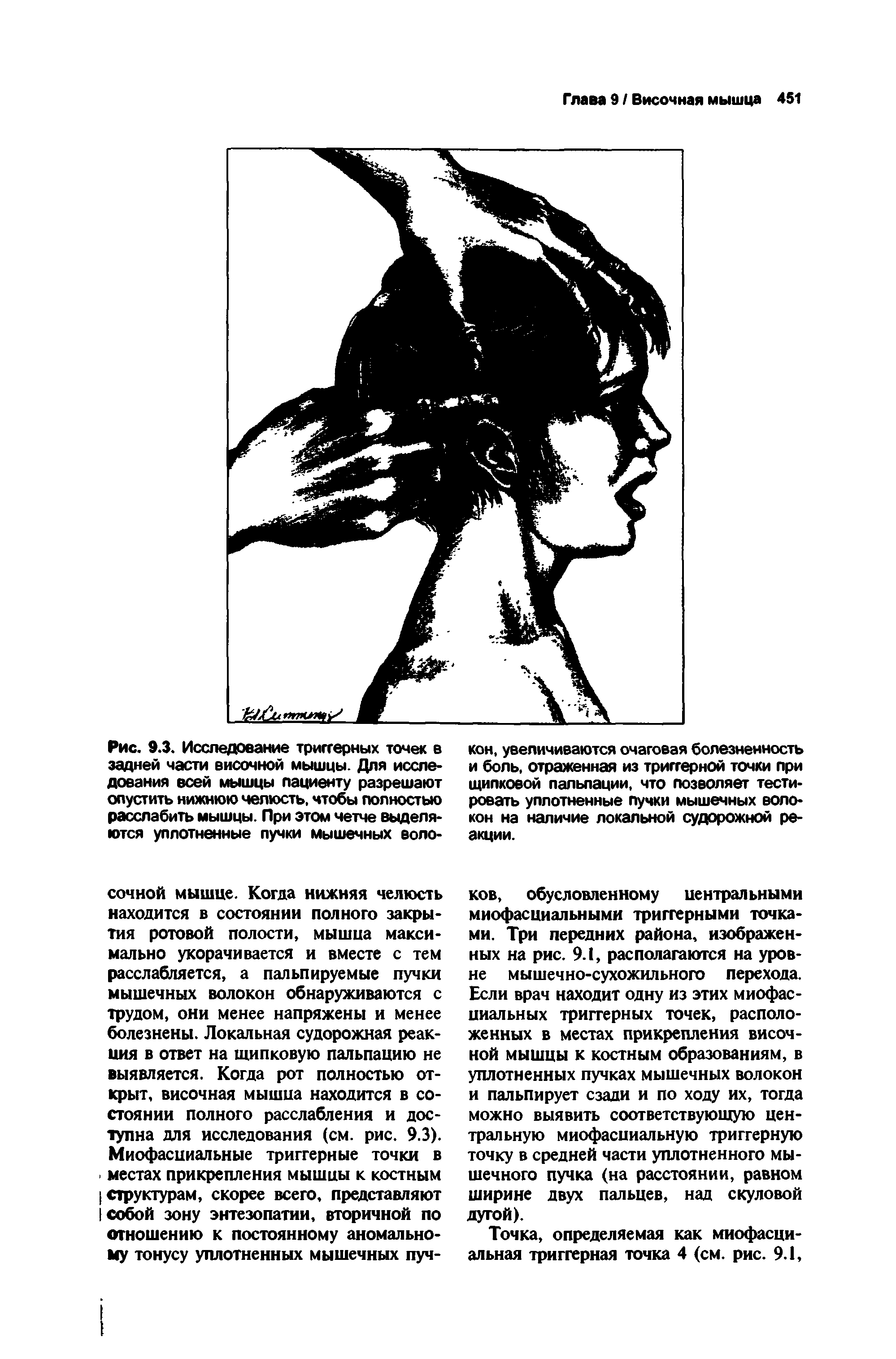 Рис. 9.3. Исследование триггерных точек в задней части височной мышцы. Для исследования всей мышцы пациенту разрешают опустить нижнюю челюсть, чтобы полностью расслабить мышцы. При этом четче выделяются уплотненные пучки мышечных воло-...