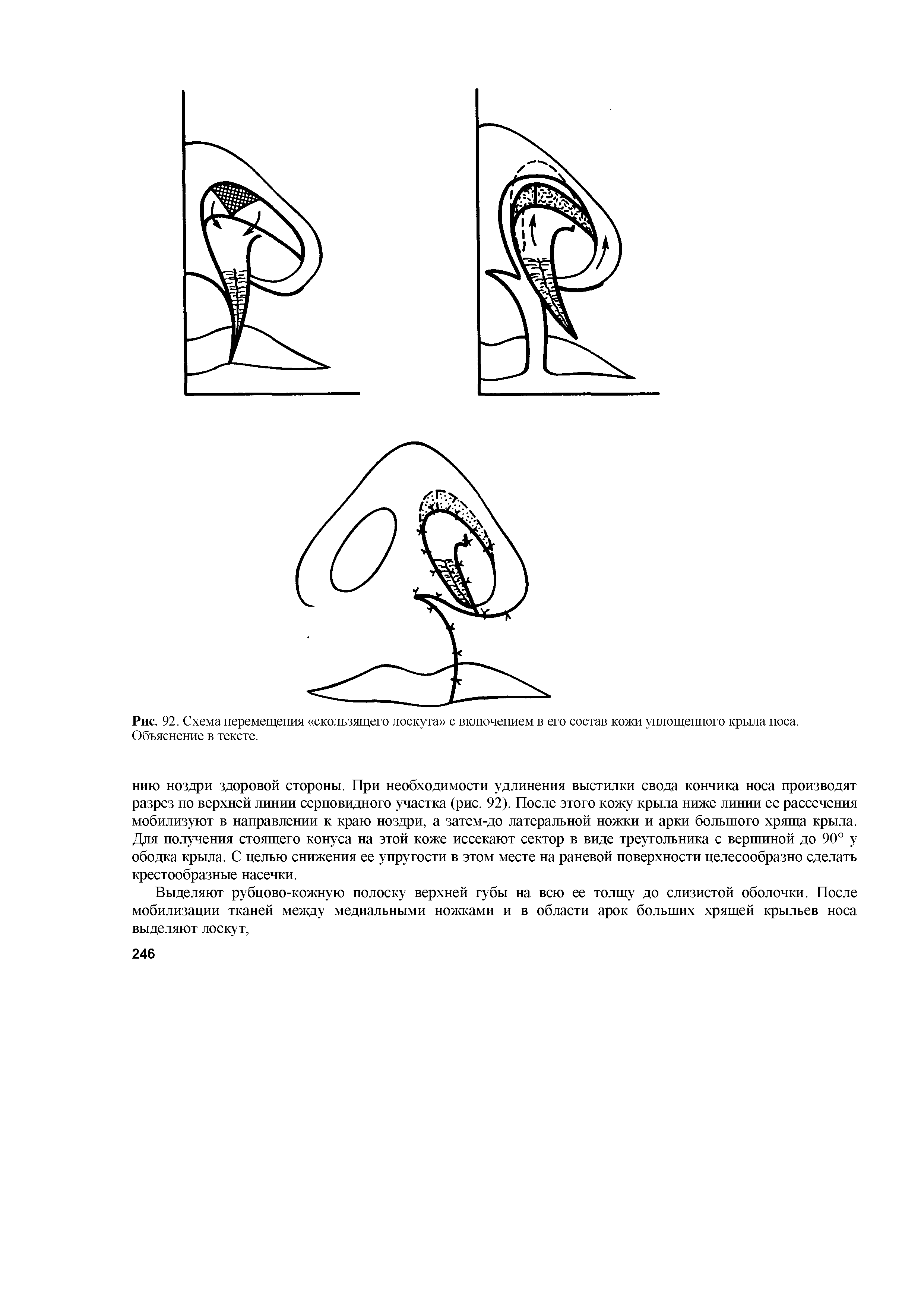 Рис. 92. Схема перемещения скользящего лоскута с включением в его состав кожи уплощенного крыла носа. Объяснение в тексте.