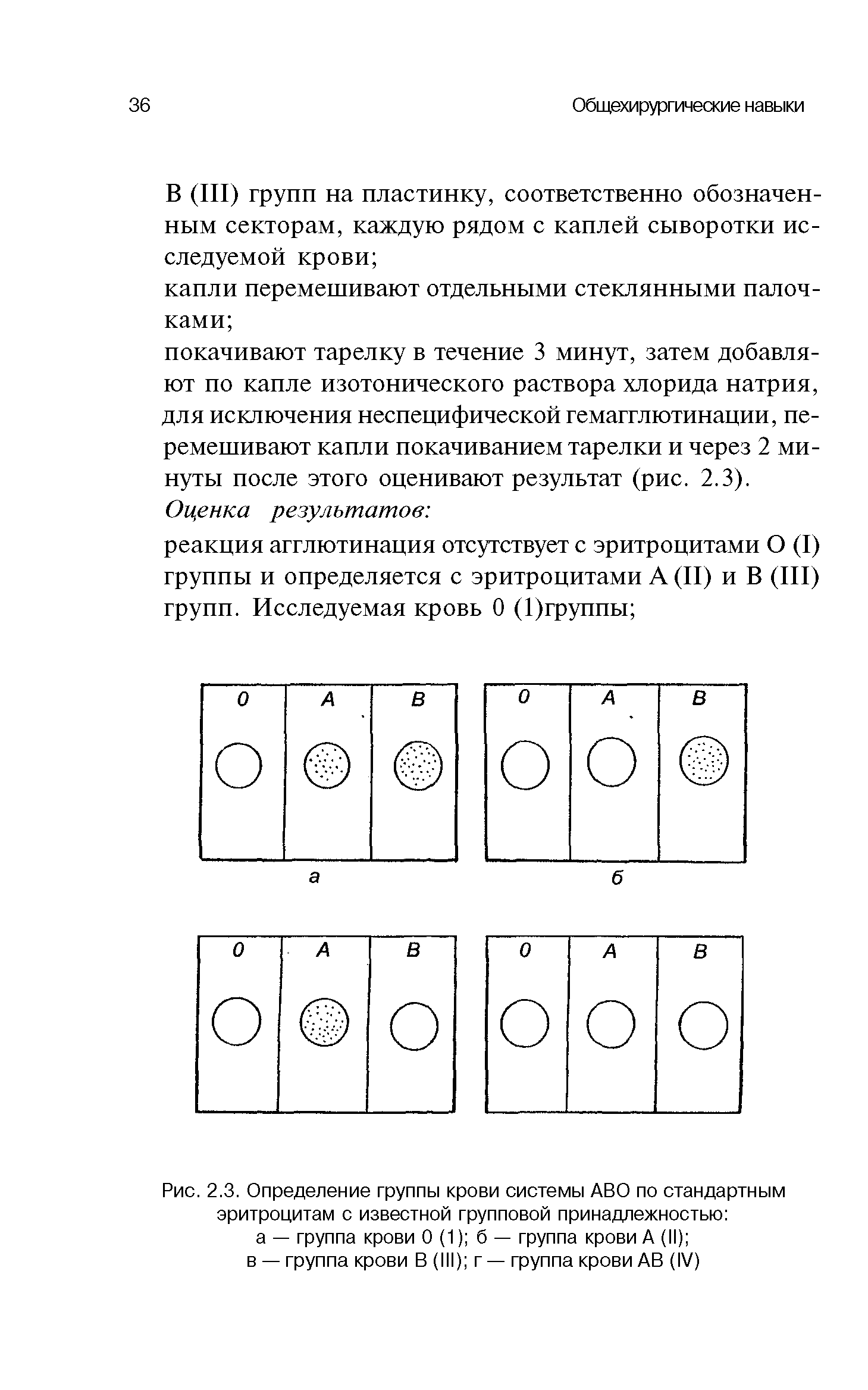 Рис. 2.3. Определение группы крови системы ABO по стандартным эритроцитам с известной групповой принадлежностью а — группа крови 0 (1) б — группа крови А (II) ...