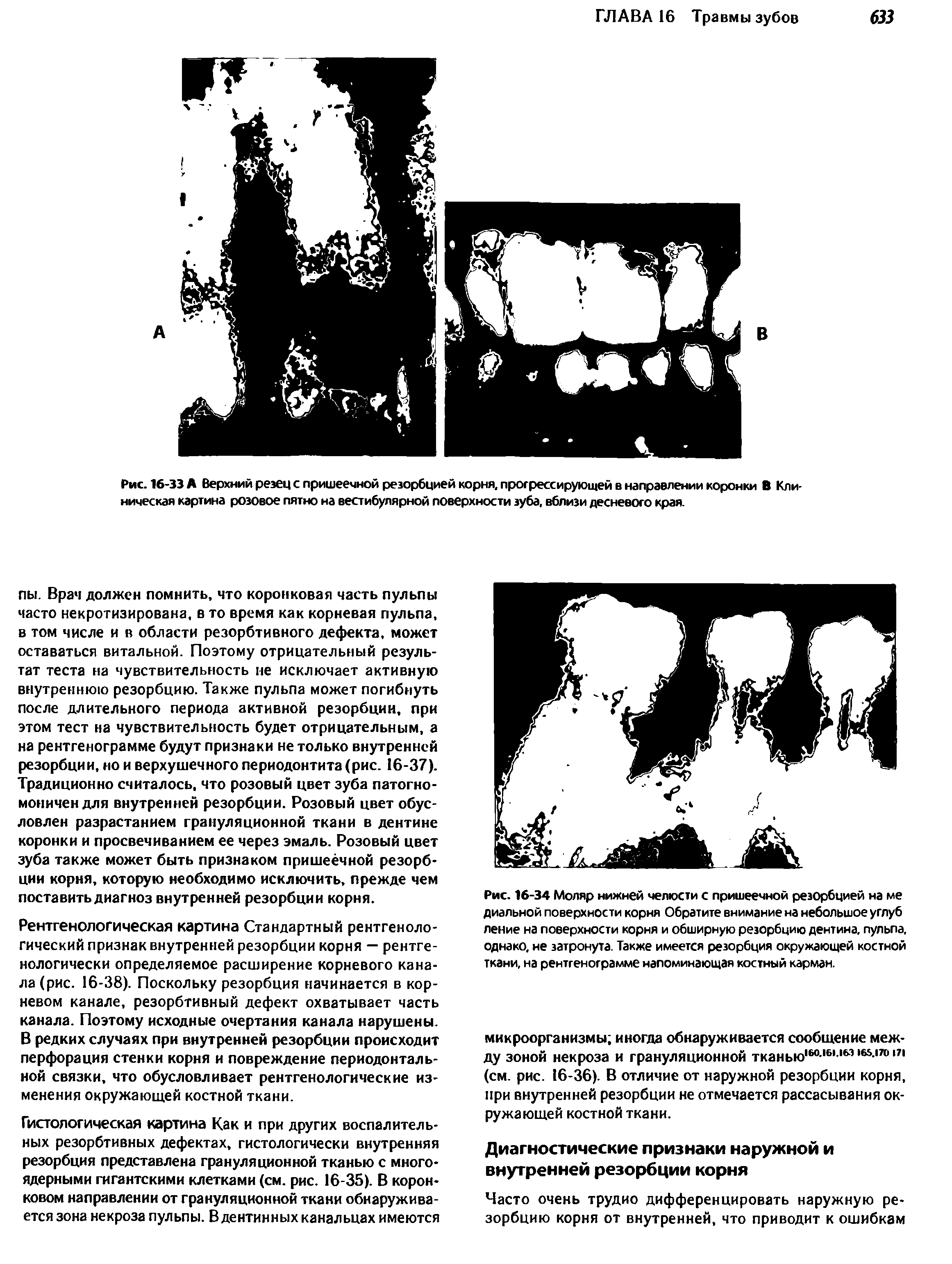 Рис. 16-33 А Верхний резец с пришеечной резорбцией корня, прогрессирующей в направлении коронки В Клиническая картина розовое пятно на вестибулярной поверхности зуба, вблизи десневого края.
