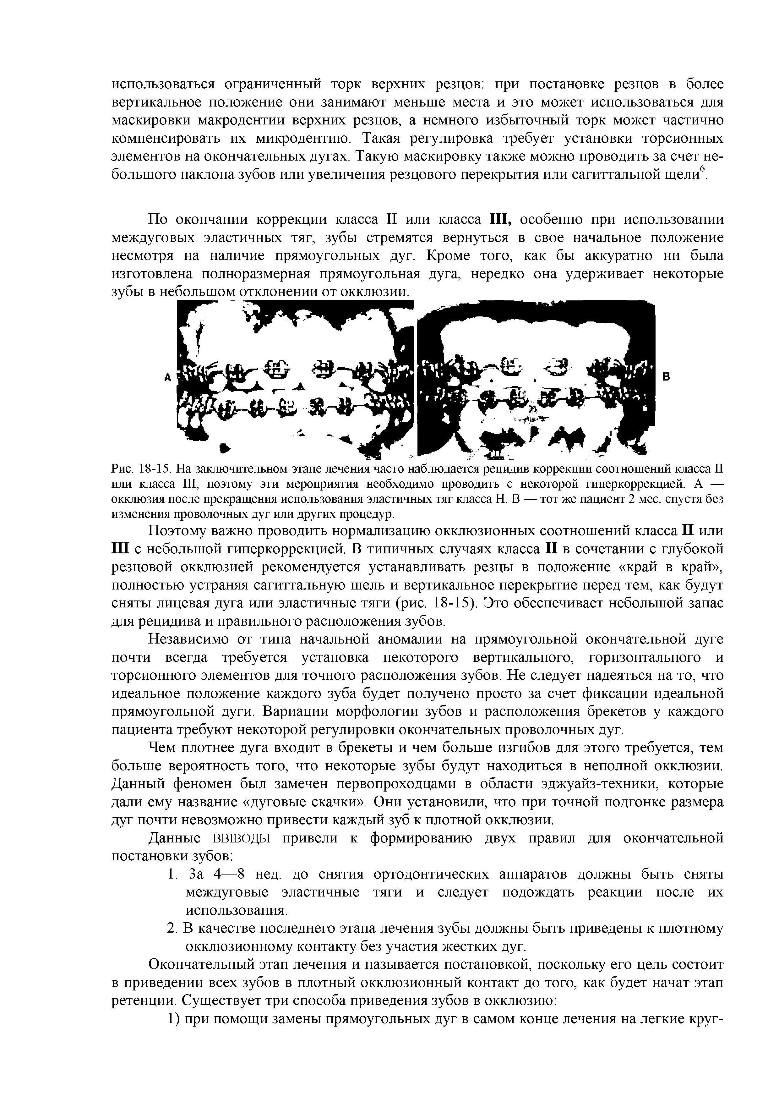 Рис. 18-15. На заключительном этапе лечения часто наблюдается рецидив коррекции соотношений класса II или класса III, поэтому эти мероприятия необходимо проводить с некоторой гиперкоррекцией. А — окклюзия после прекращения использования эластичных тяг класса Н. В — тот же пациент 2 мес. спустя без изменения проволочных дуг или других процедур.