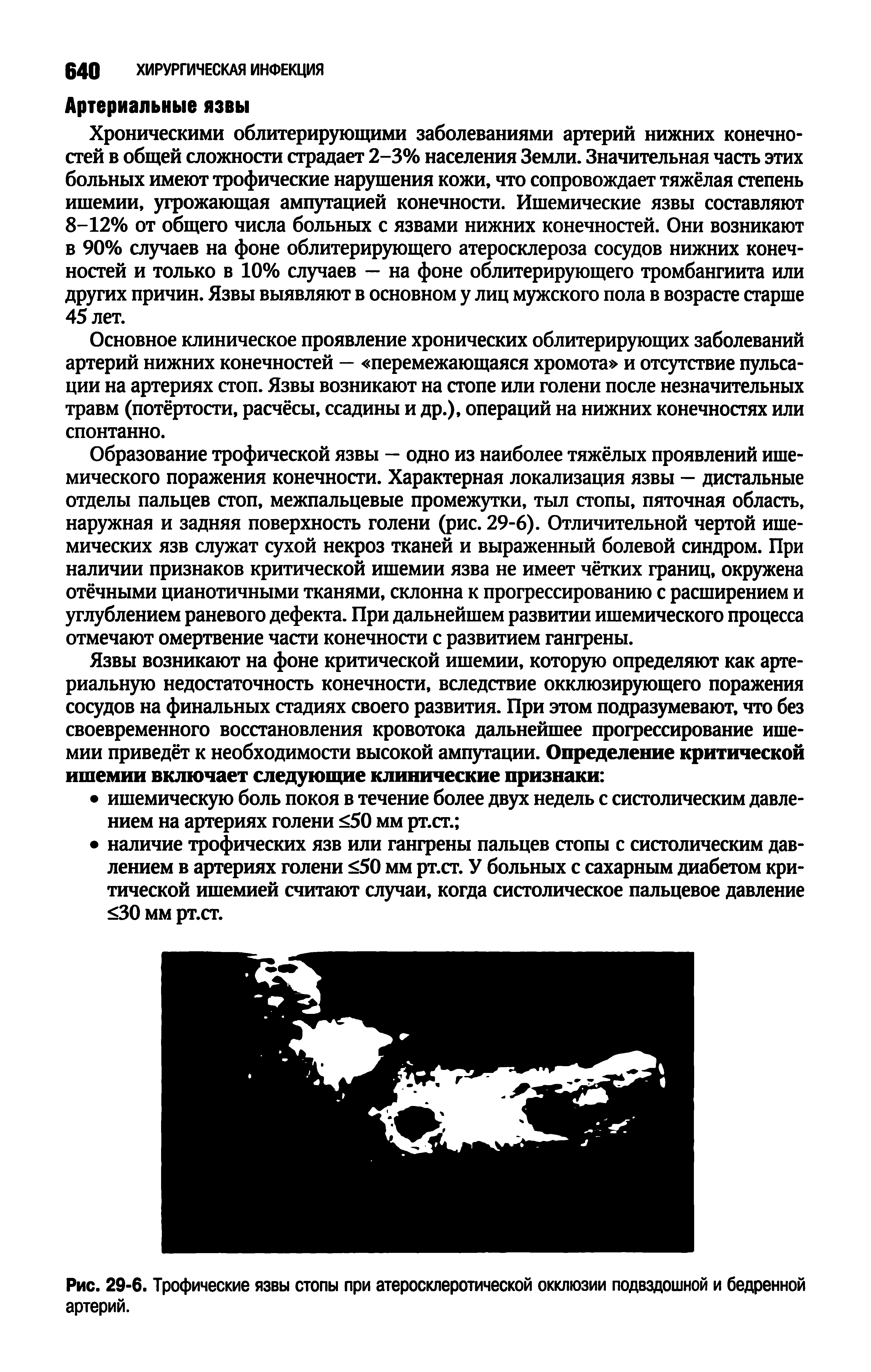 Рис. 29-6. Трофические язвы стопы при атеросклеротической окклюзии подвздошной и бедренной артерий.