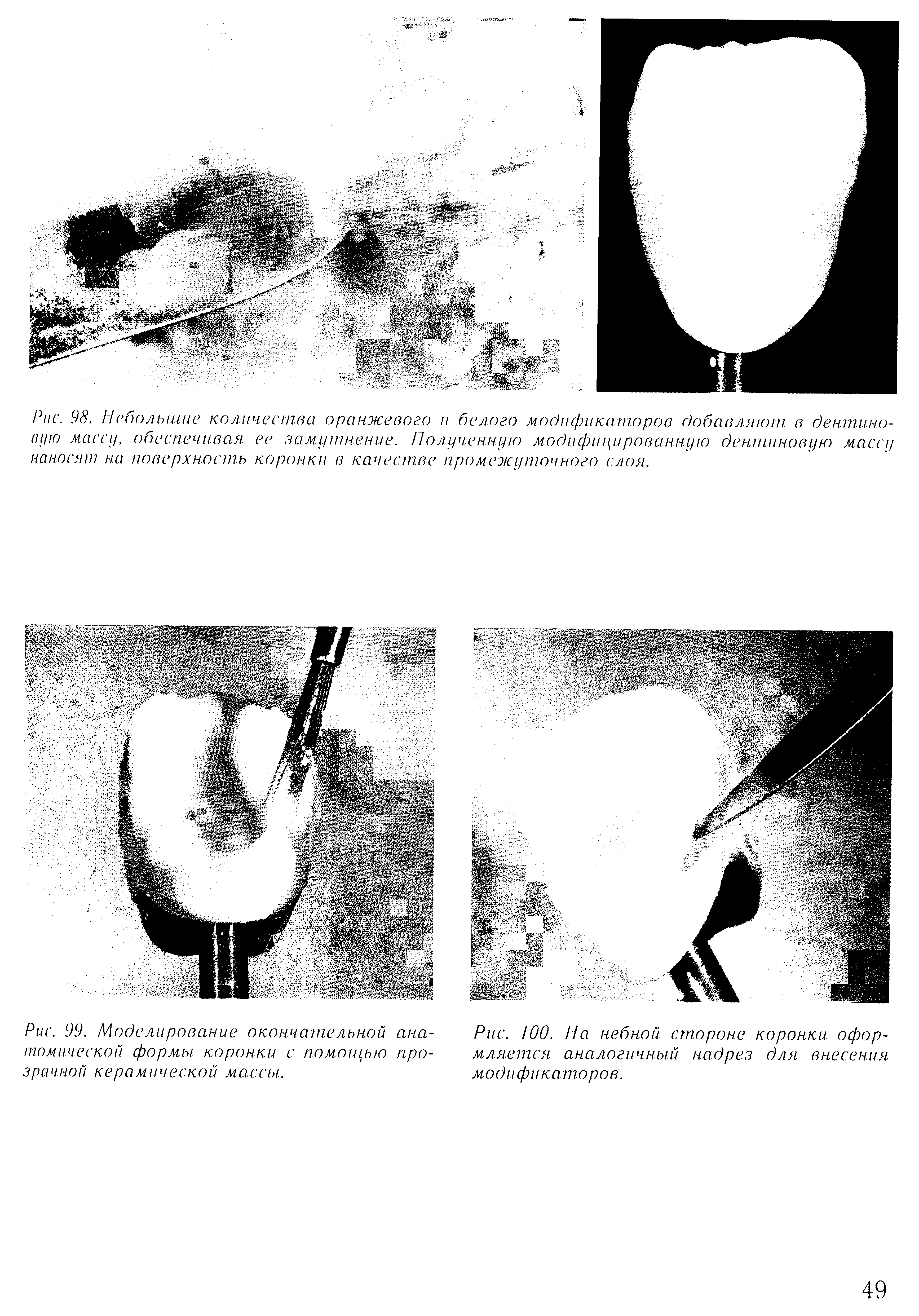 Рис. 99. Моделирование окончительной анатомической формы, коронки с помощью прозрачной керамической массы.