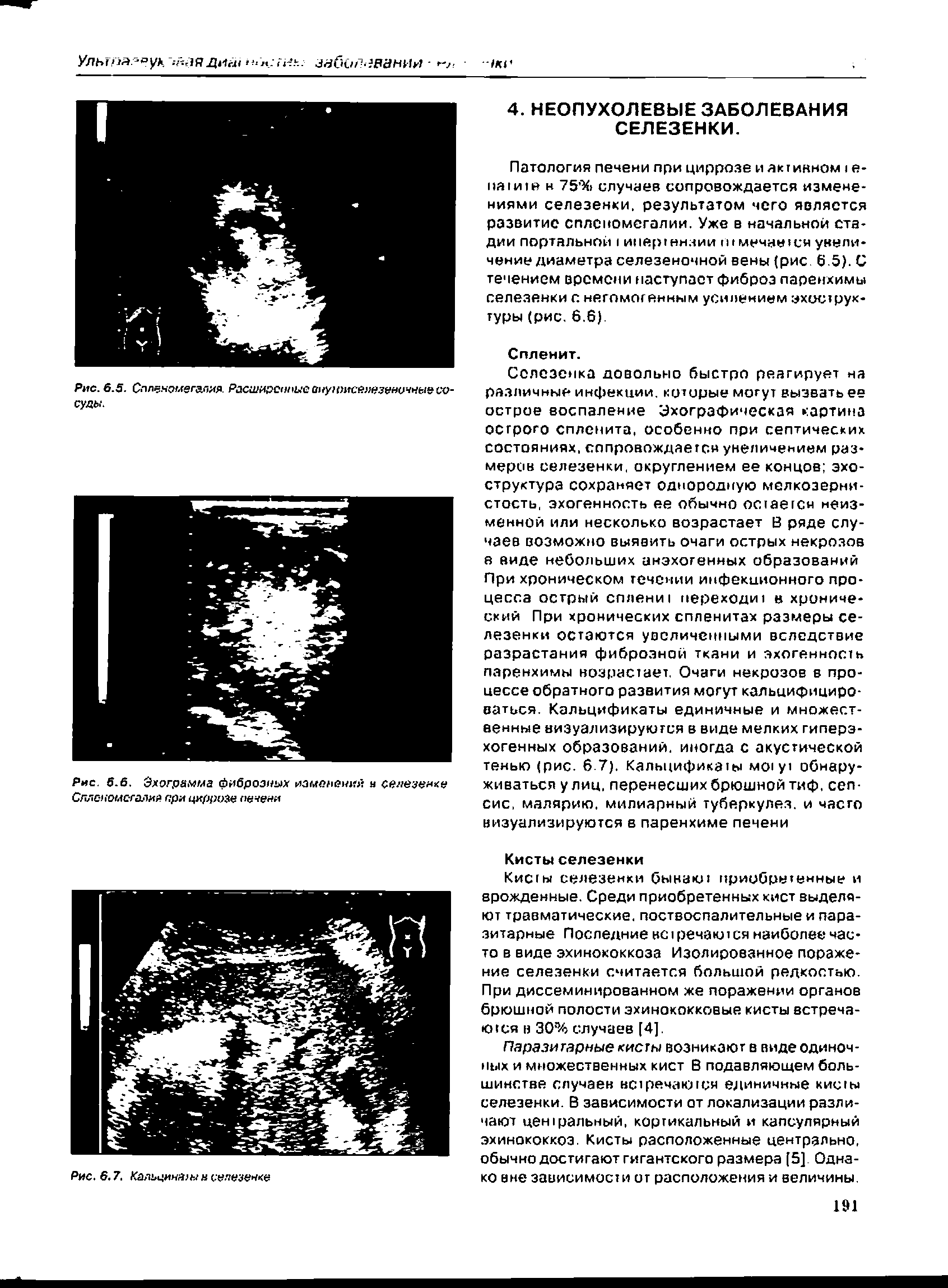 Рис. 5.6. Эхограмма фиброзных изменений я селезенке Спленомегалий при цирроза печени...