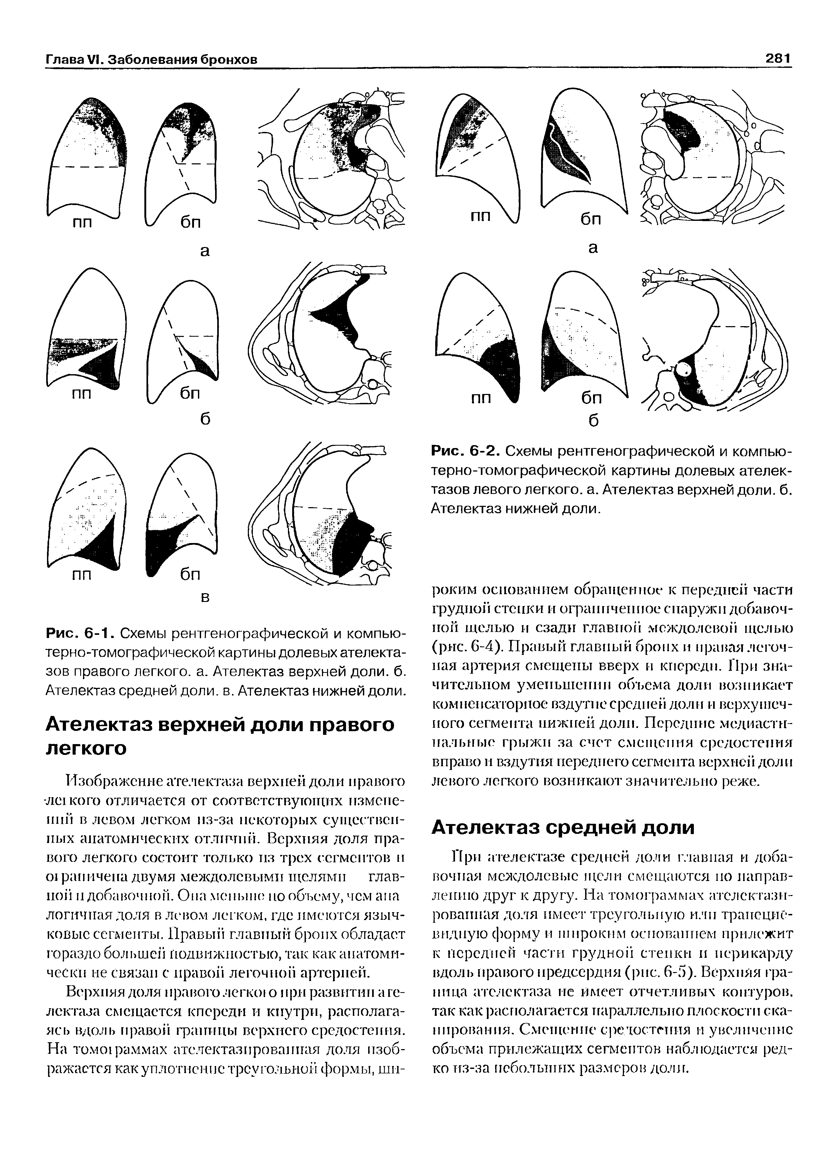 Рис. 6-2. Схемы рентгенографической и компьютерно-томографической картины долевых ателектазов левого легкого, а. Ателектаз верхней доли. б. Ателектаз нижней доли.