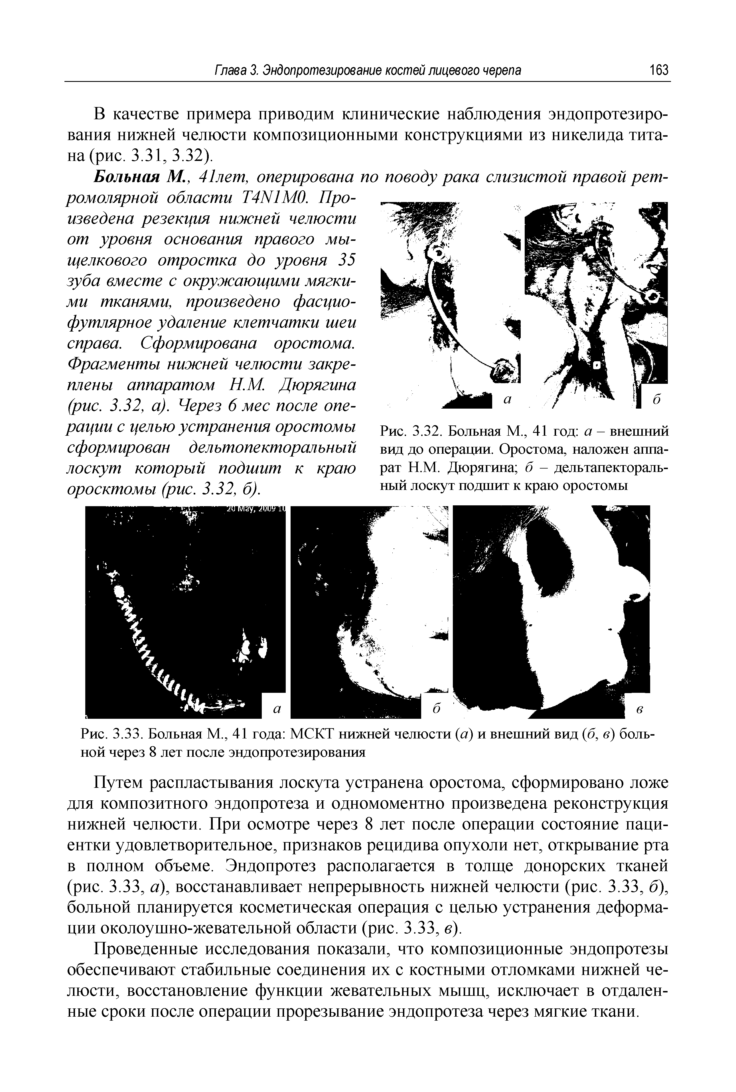 Рис. 3.33. Больная М., 41 года МСКТ нижней челюсти (а) и внешний вид (б, в) больной через 8 лет после эндопротезирования...