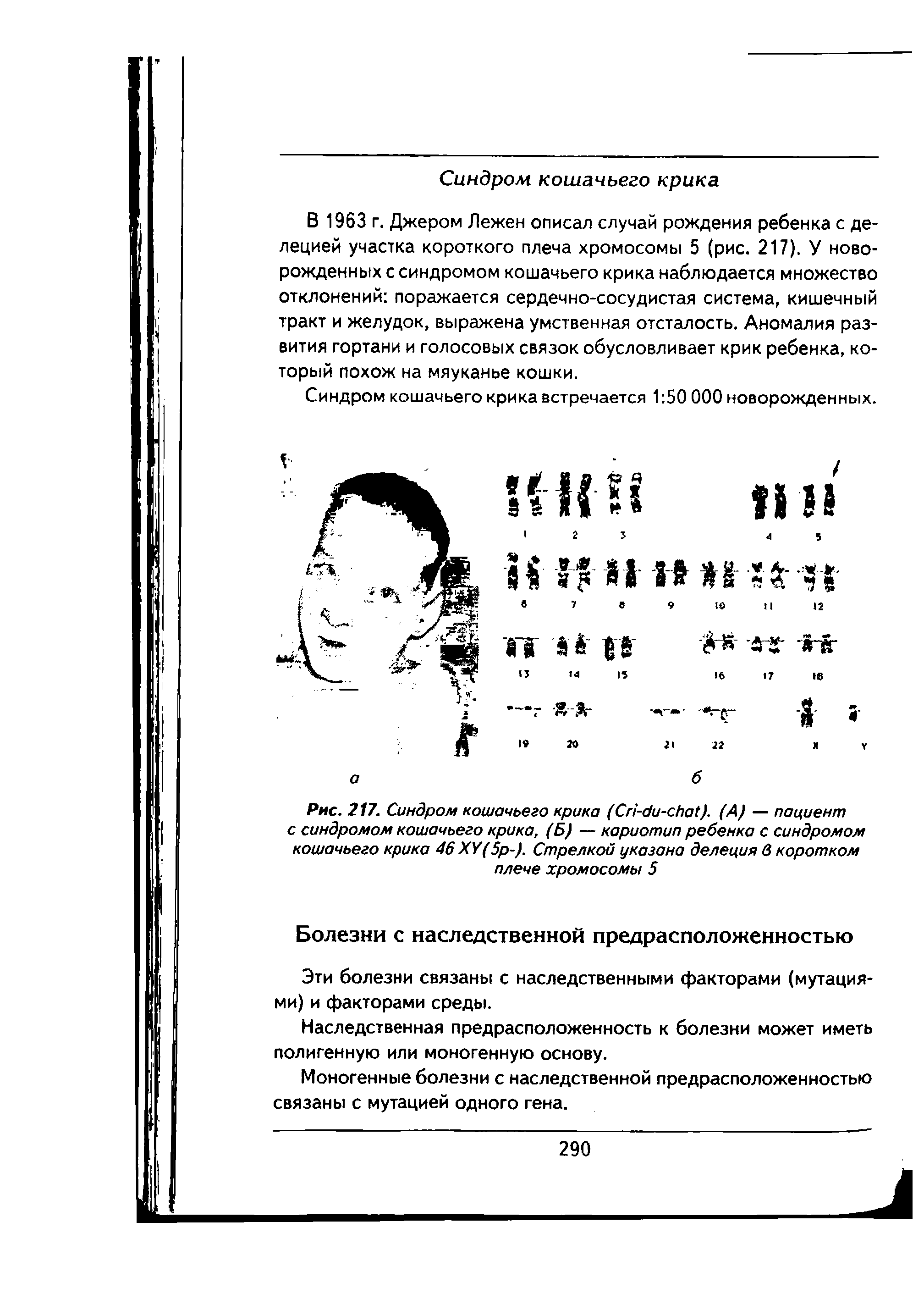 Рис. 217. Синдром кошачьего крика (Сп-би-сба. (А) — пациент с синдромом кошачьего крика, (Б) — кариотип ребенка с синдромом кошачьего крика 46 ХУ(5р-). Стрелкой указана делеция в коротком плече хромосомы 5...