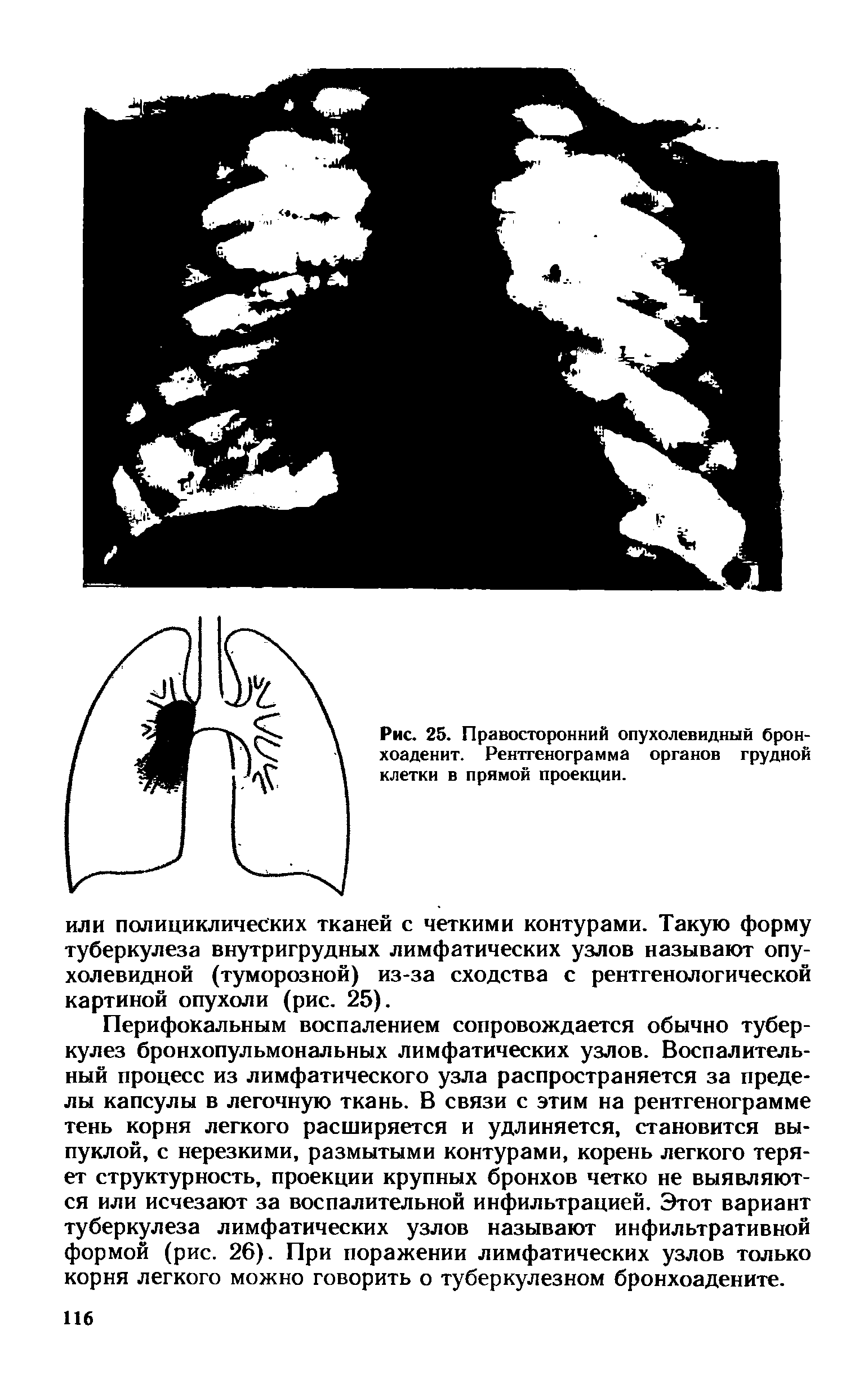 Рис. 25. Правосторонний опухолевидный бронхоаденит. Рентгенограмма органов грудной клетки в прямой проекции.