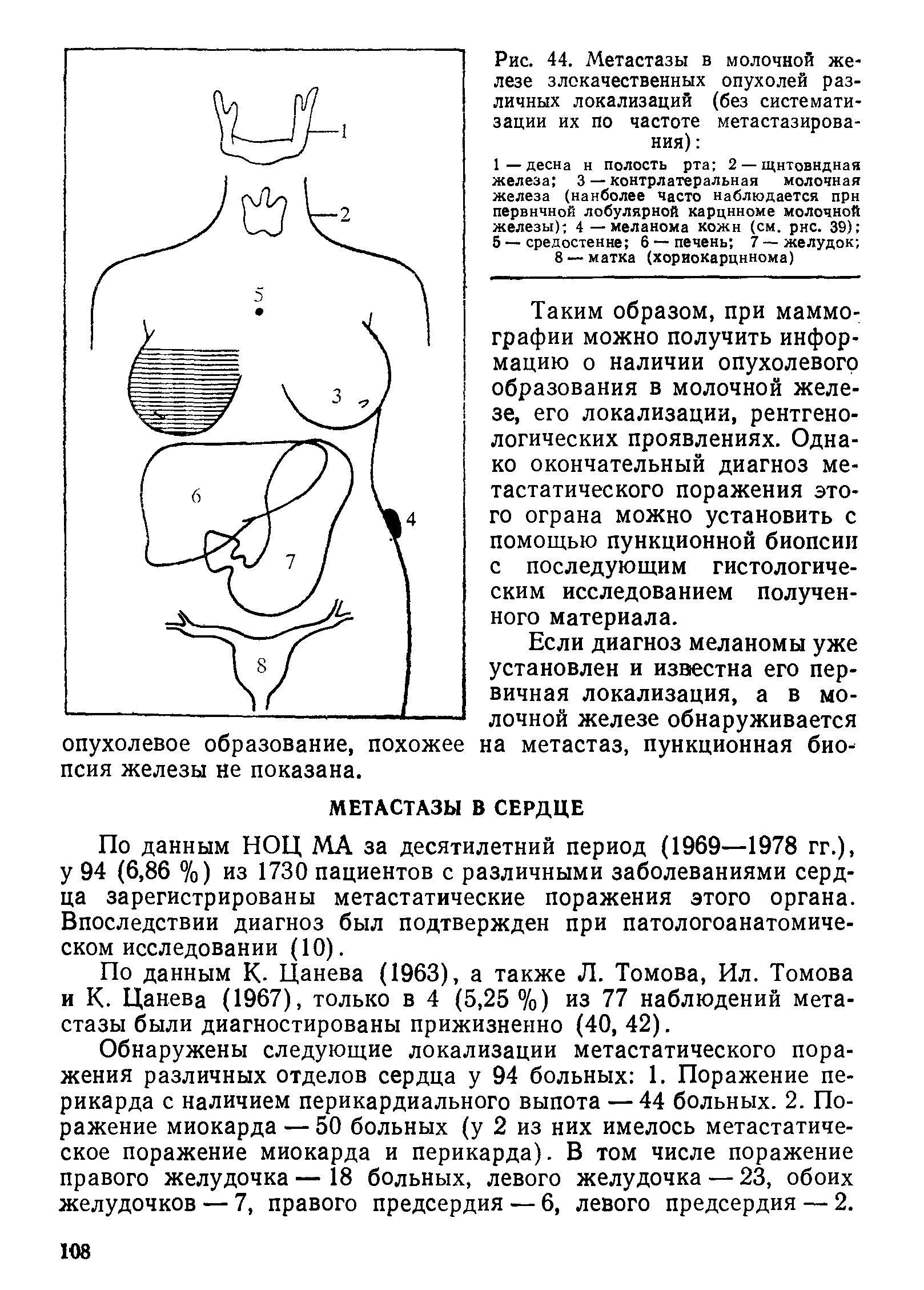 Рис. 44. Метастазы в молочной железе злокачественных опухолей различных локализаций (без систематизации их по частоте метастазирования) ...