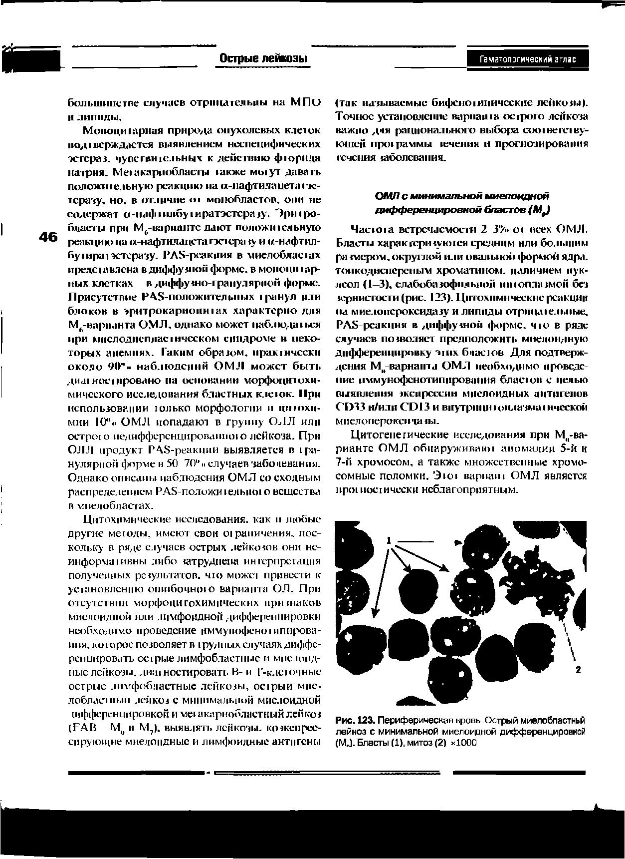 Рис. 123. Периферическая кровь Острый миелобластный лейкоз с минимальной миелоидной дифференцировкой (М ). Бласты (1), митоз (2) х1000...