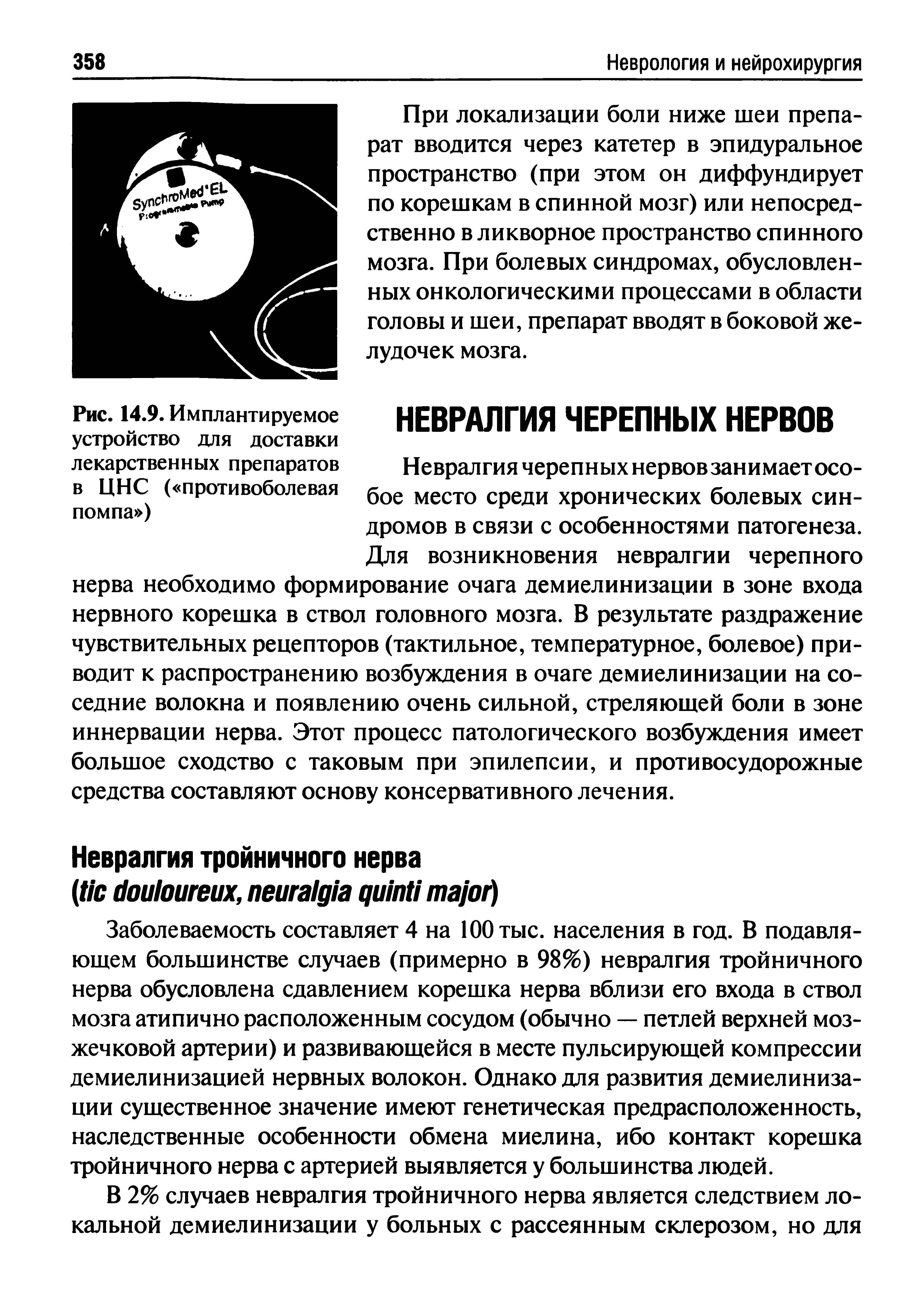 Рис. 14.9. Имплантируемое устройство для доставки лекарственных препаратов в ЦНС ( противоболевая помпа ) НЕВРАЛГИЯ ЧЕРЕПНЫХ НЕРВОВ Невралгия черепных нервов занимает особое место среди хронических болевых синдромов в связи с особенностями патогенеза. Для возникновения невралгии черепного...