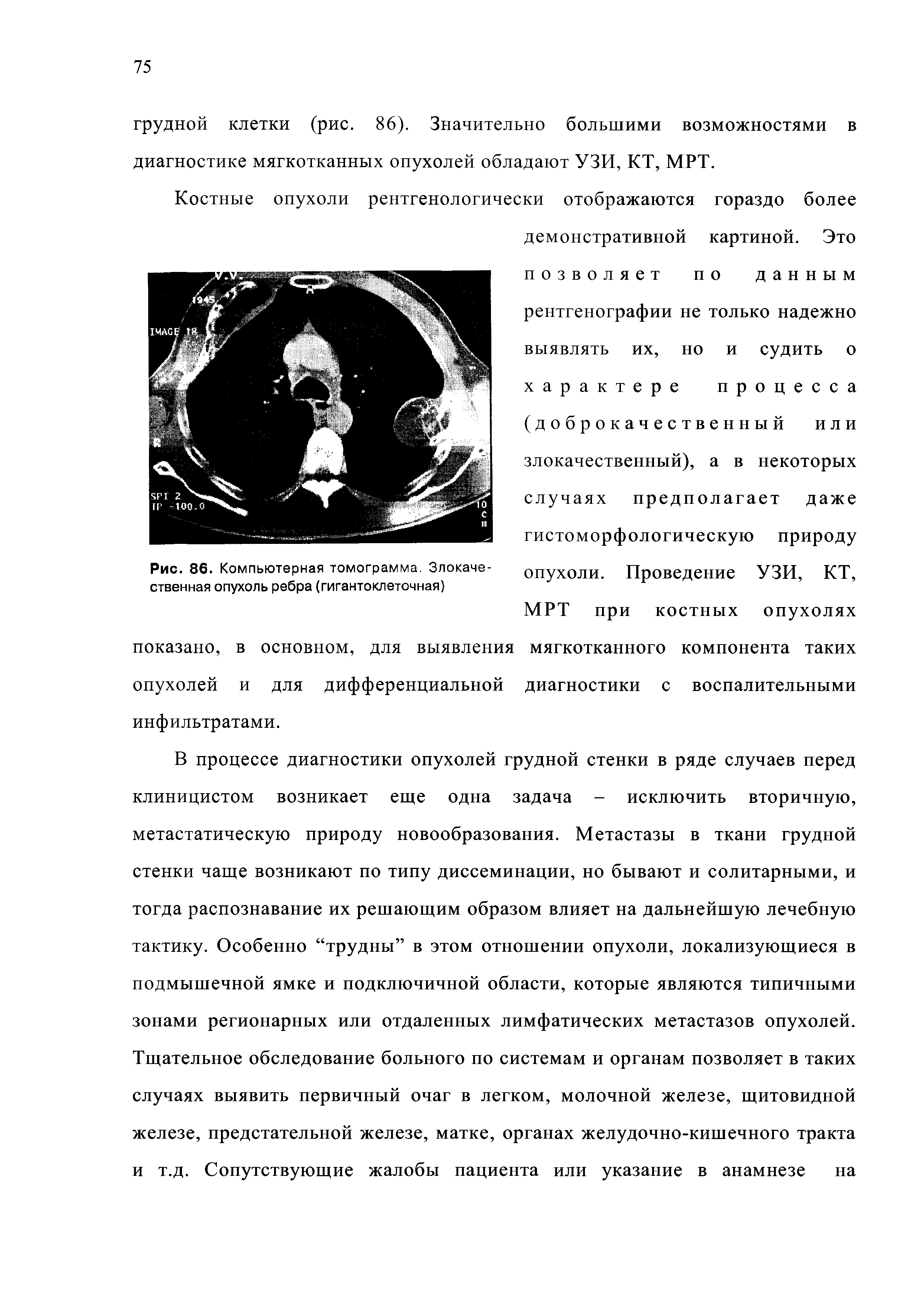 Рис. 86. Компьютерная томограмма. Злокачественная опухоль ребра (гигантоклеточная)...