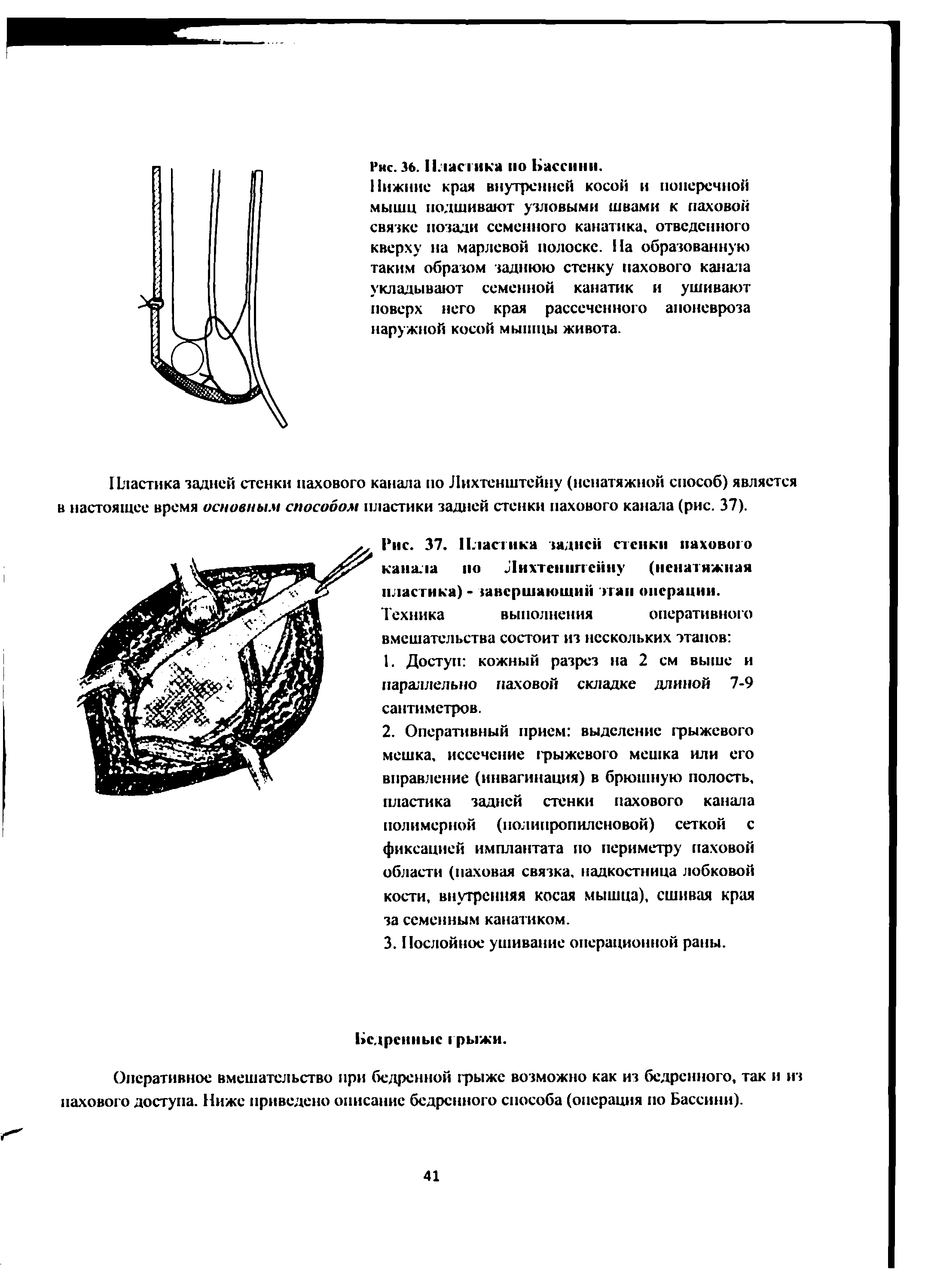 Рис. 37. Пластика задней стенки пахового канала по Лихтенштейну (ненатяжная пластика) - гавершаюший пап операции.