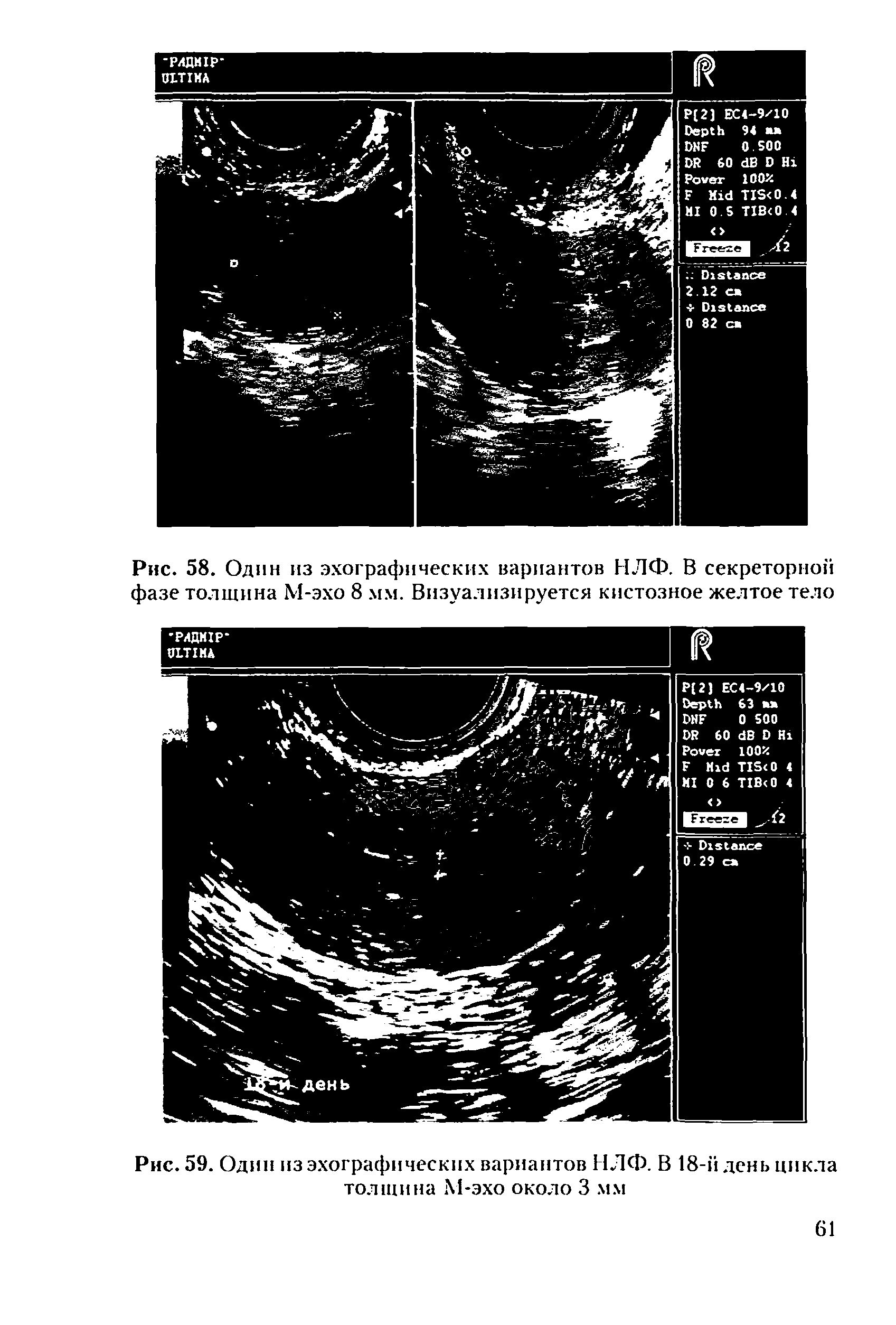Рис. 58. Один из эхографических вариантов НЛФ. В секреторной фазе толщина М-эхо 8 мм. Визуализируется кистозное желтое тело...