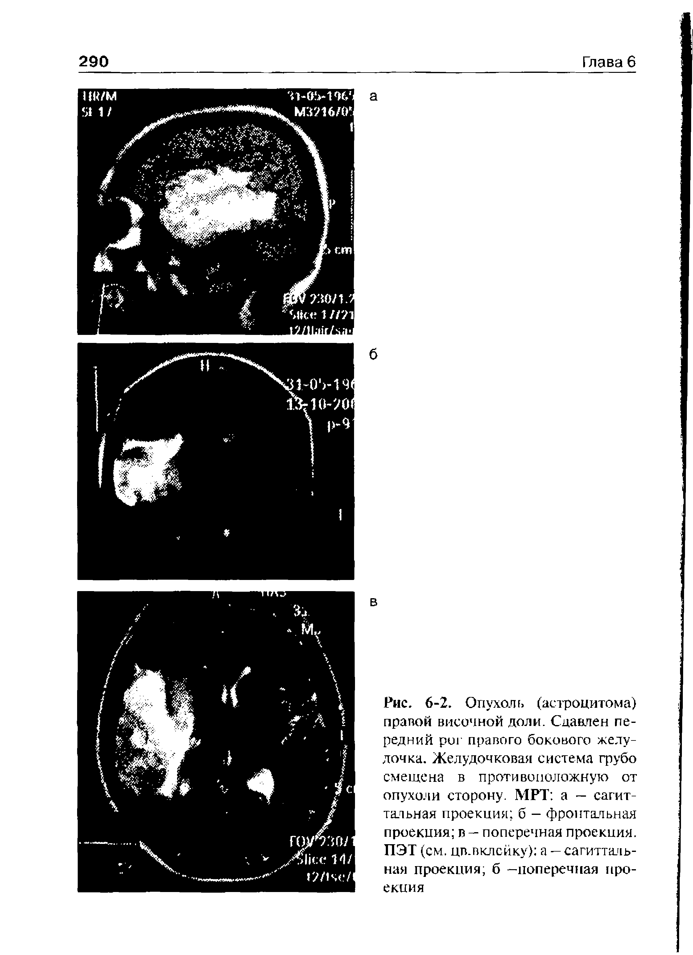 Рис. 6-2. Опухоль (астроцитома) правой височной доли. Сдавлен передний риг правого бокового желудочка. Желудочковая система грубо смещена в противоположную от опухоли сторону. МРТ а — сагиттальная проекция б — фронтальная проекция в — поперечная проекция. ПЭТ (см. цв.вклсйку) а — сагиттальная проекция, б —поперечная проекция...