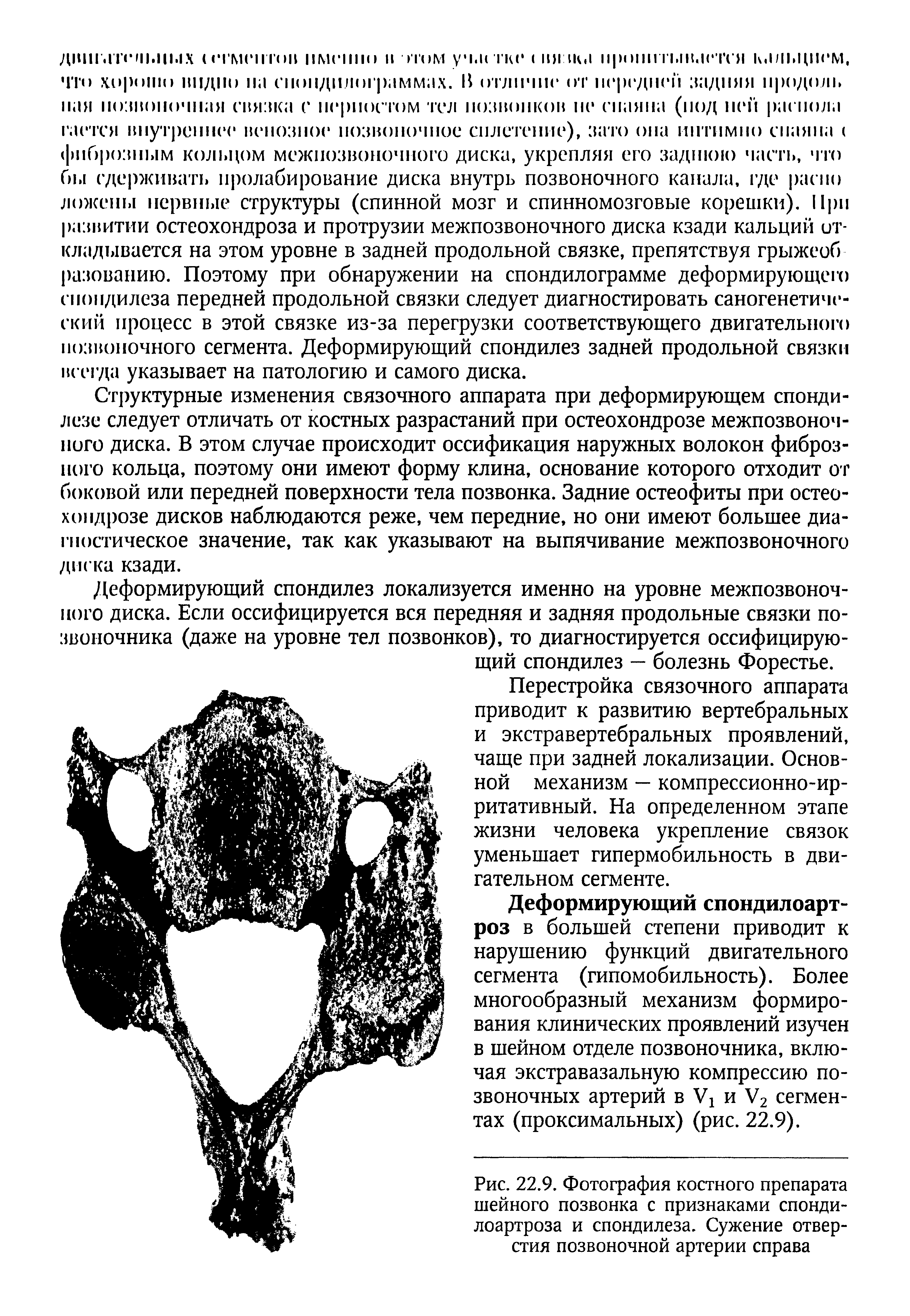 Рис. 22.9. Фотография костного препарата шейного позвонка с признаками спонди-лоартроза и спондилеза. Сужение отверстия позвоночной артерии справа...