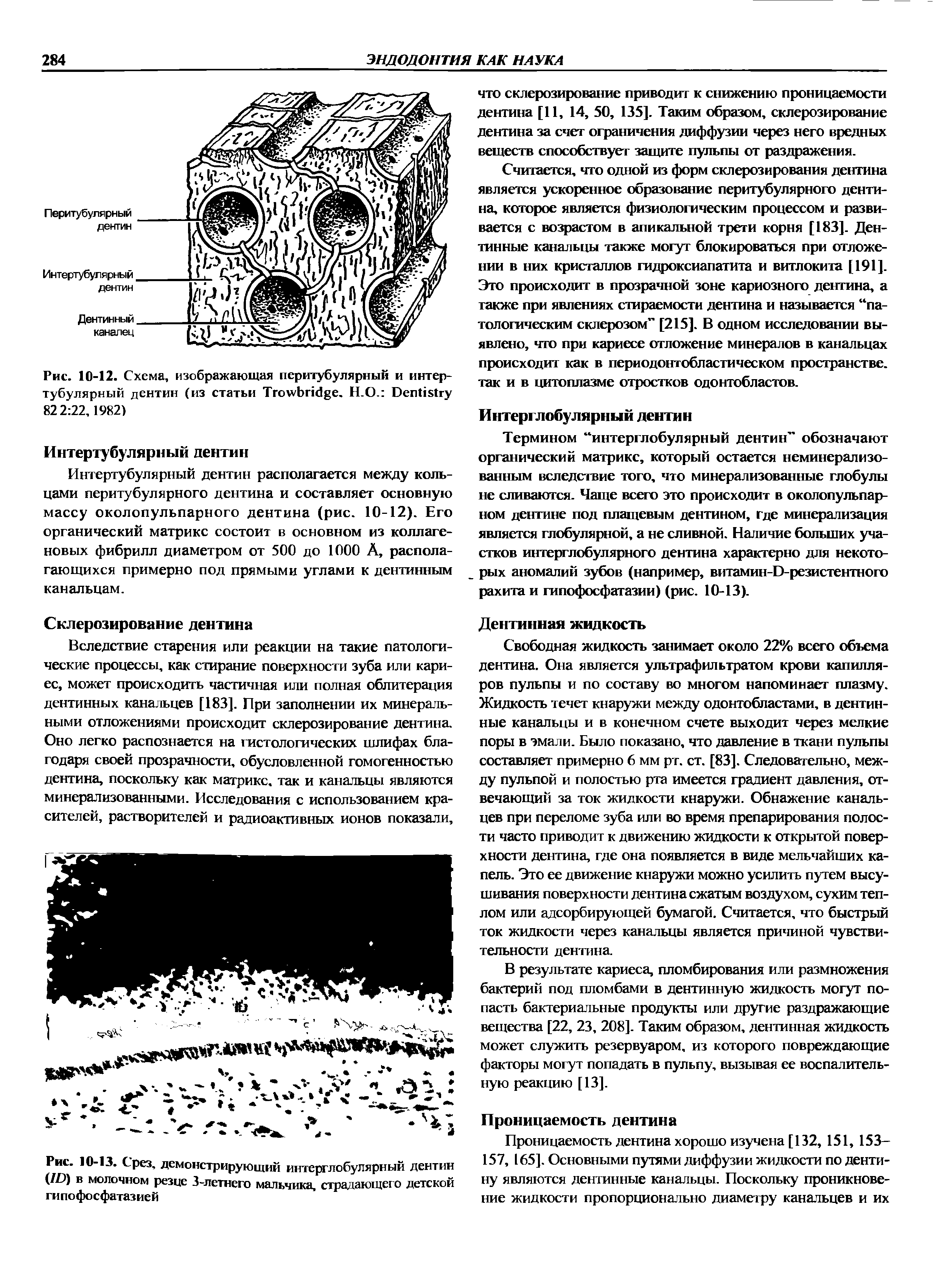 Рис. 10-13. Срез, демонстрирующий интерглобулярный дентин (Ю) в молочном резце 3-летнего мальчика, страдающего детской гипофосфатазией...