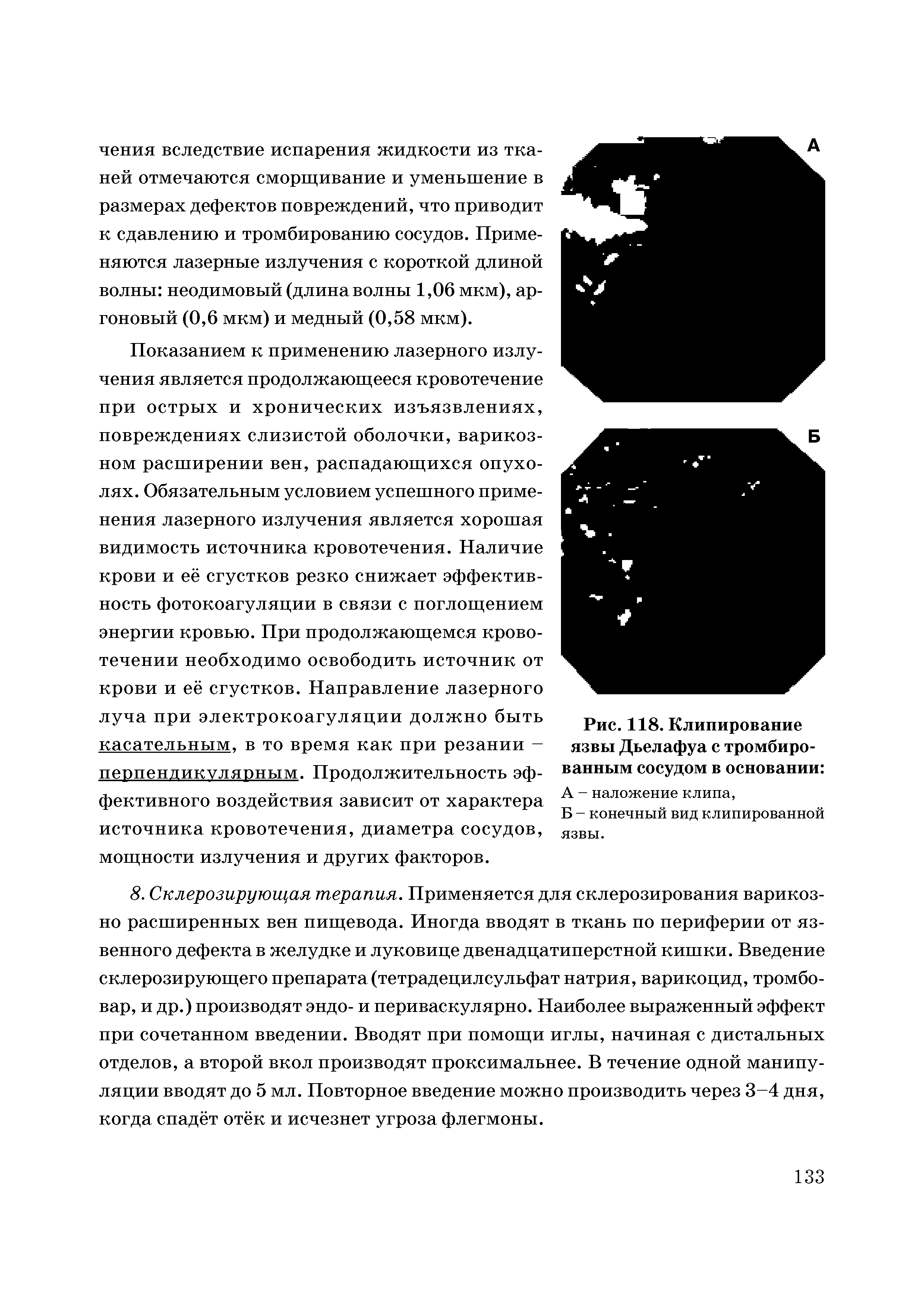 Рис. 118. Клипирование язвы Дьелафуа с тромбированным сосудом в основании ...