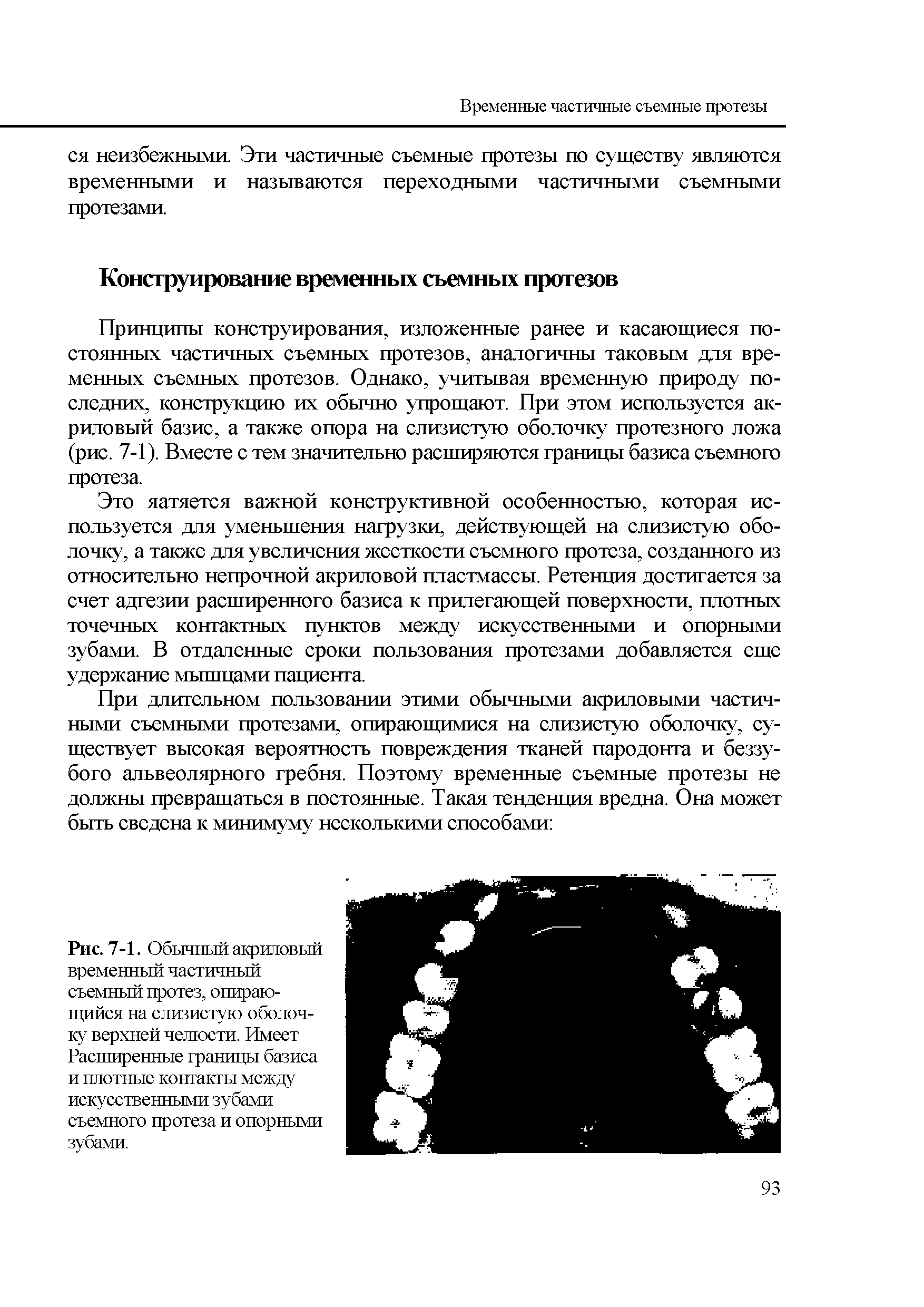 Рис. 7-1. Обычный акриловый временный частичный съемный протез, опирающийся на слизистую оболочку верхней челюсти. Имеет Расширенные границы базиса и плотные контакты между искусственными зубами съемного протеза и опорными зубами.