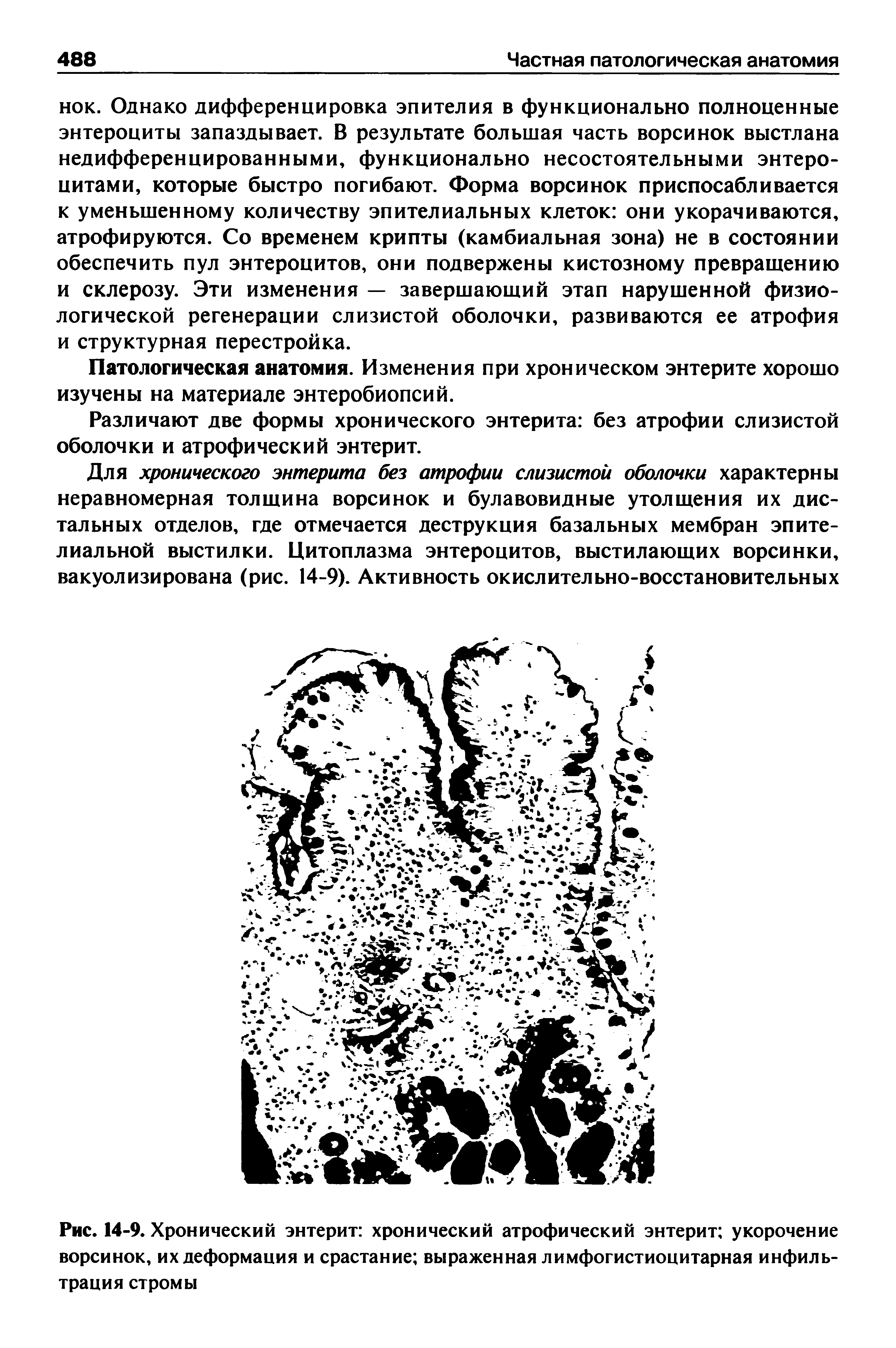 Рис. 14-9. Хронический энтерит хронический атрофический энтерит укорочение ворсинок, их деформация и срастание выраженная лимфогистиоцитарная инфильтрация стромы...