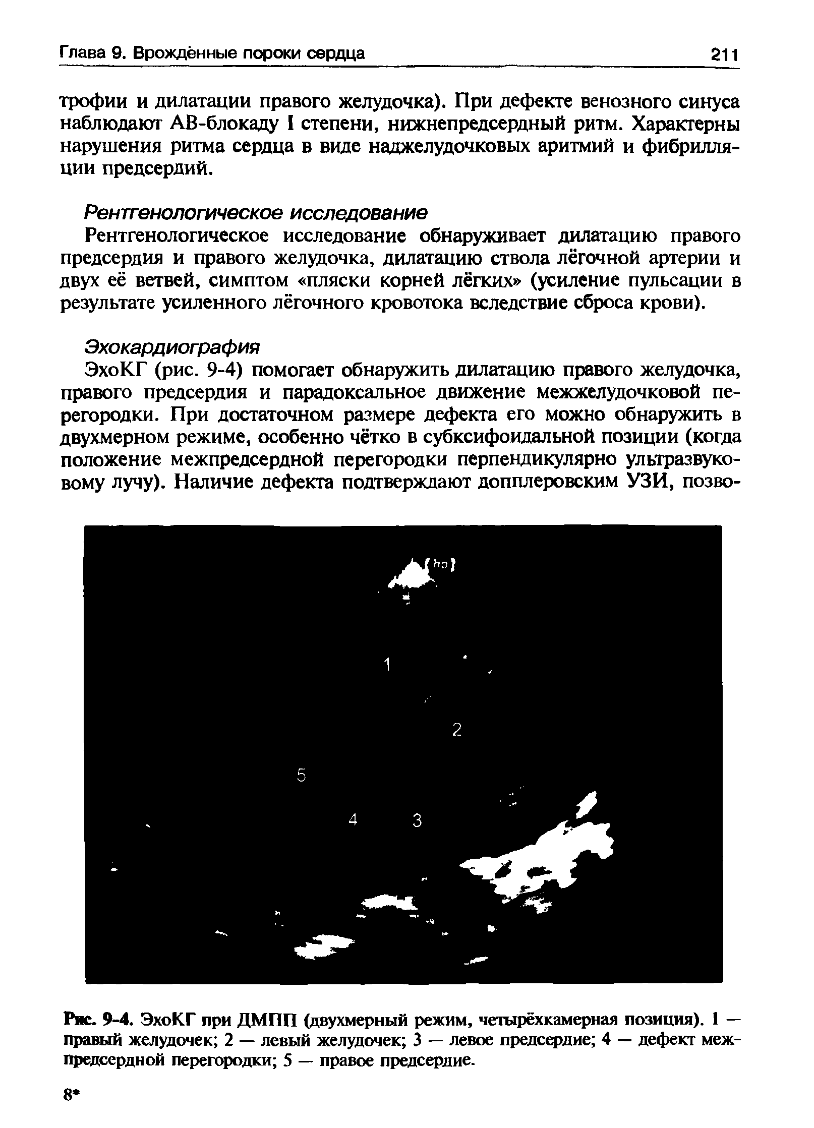 Рис. 9-4. ЭхоКГ при ДМПП (двухмерный режим, четырёхкамерная позиция). 1 — правый желудочек 2 — левый желудочек 3 — левое предсердие 4 — дефект межпредсердной перегородки 5 — правое предсердие.