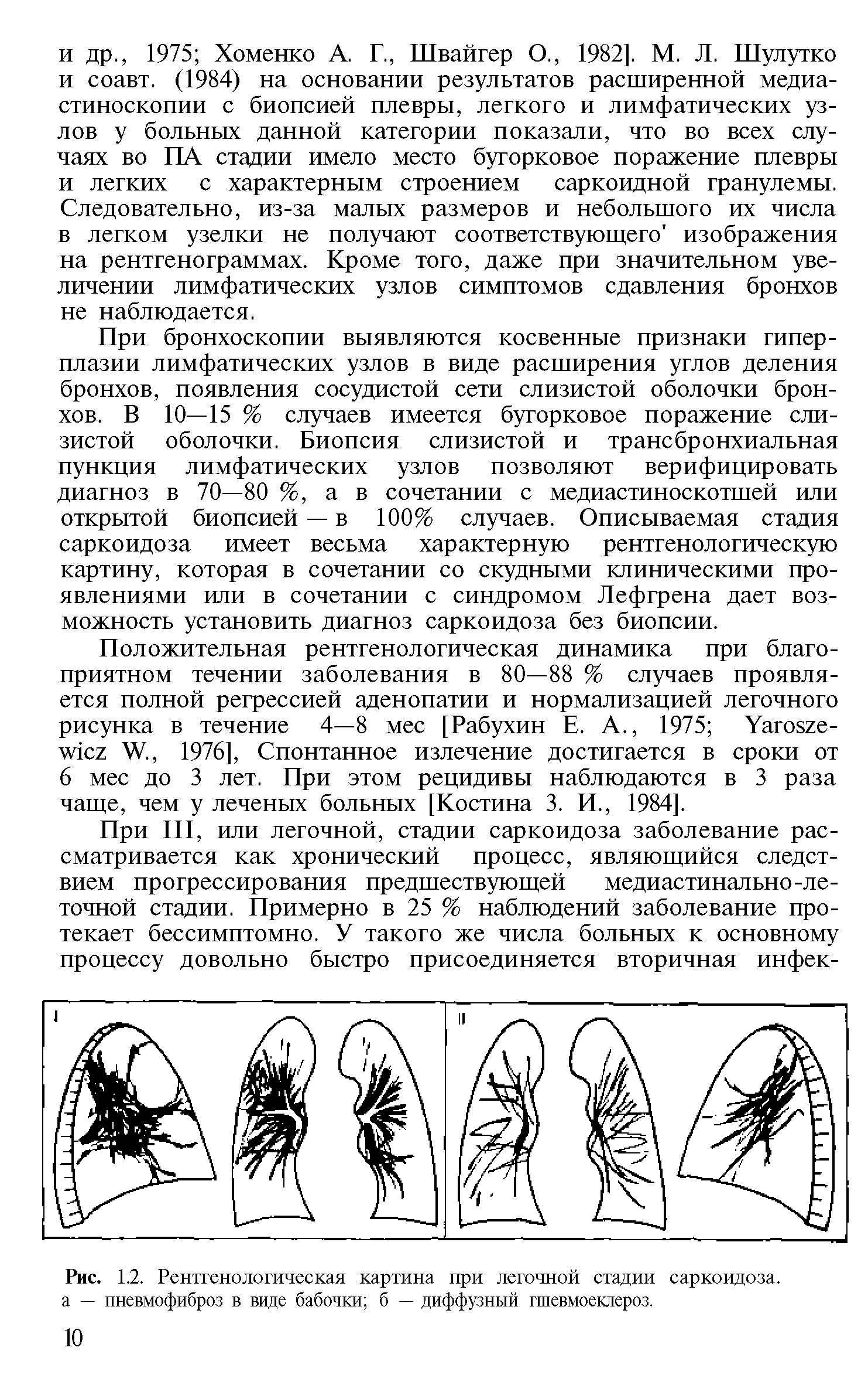 Рис. 1.2. Рентгенологическая картина при легочной стадии саркоидоза, а — пневмофиброз в виде бабочки б — диффузный гшевмоеклероз.