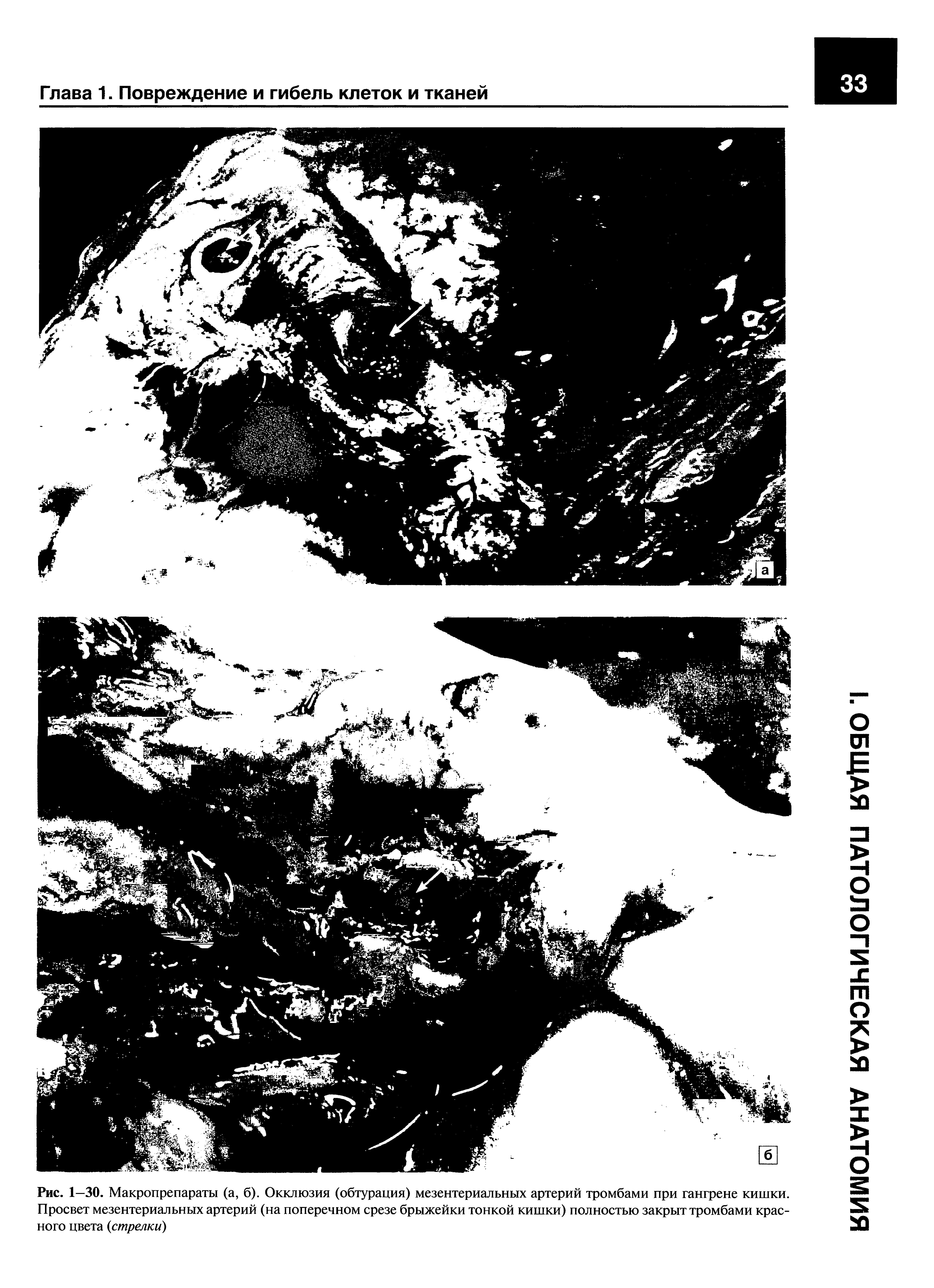 Рис. 1—30. Макропрепараты (а, б). Окклюзия (обтурация) мезентериальных артерий тромбами при гангрене кишки. Просвет мезентериальных артерий (на поперечном срезе брыжейки тонкой кишки) полностью закрыт тромбами красного цвета (стрелки)...