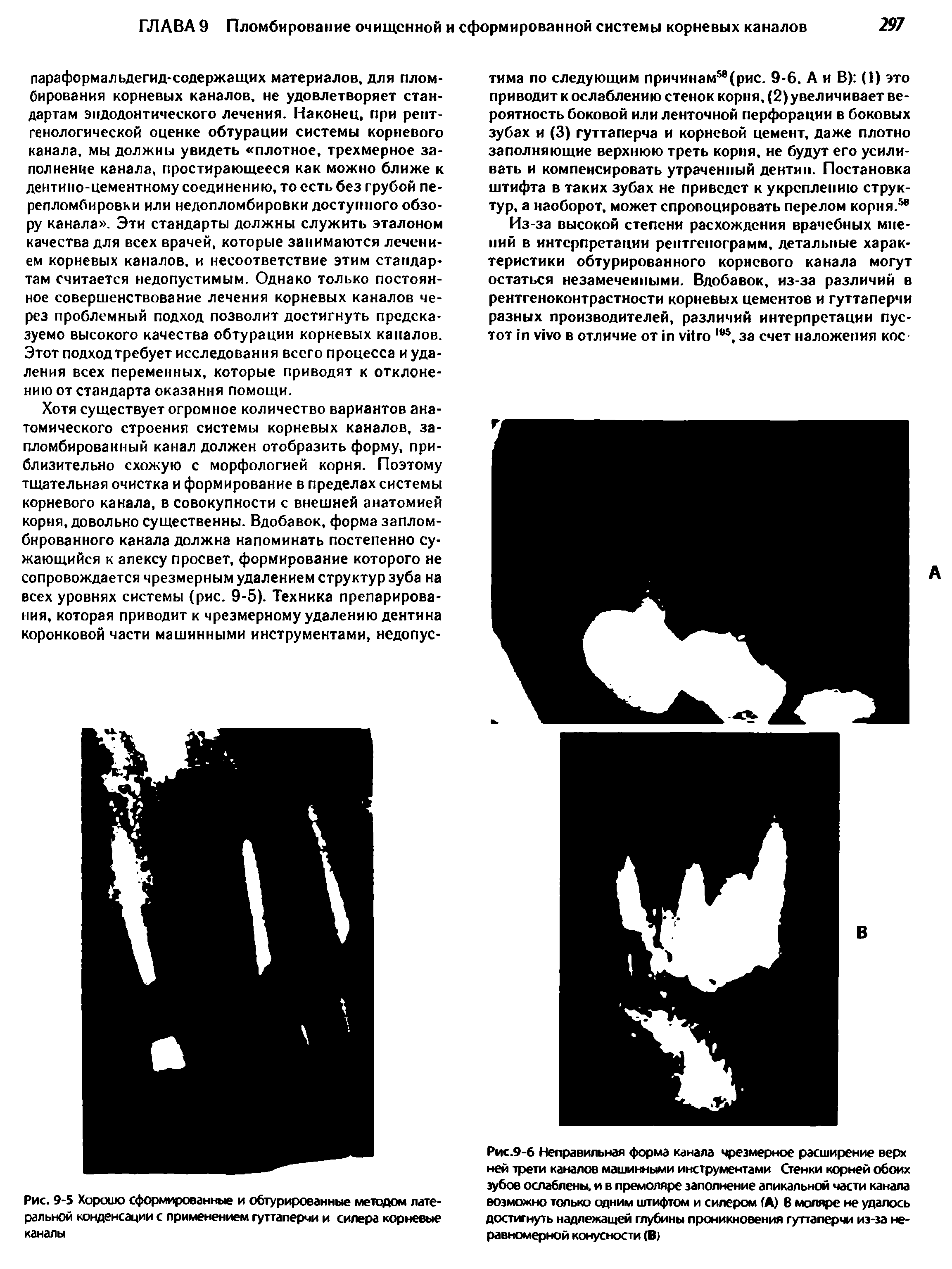 Рис. 9-5 Хорошо сформированные и обтурированные методом латеральной конденсации с применением гуттаперчи и силера корневые каналы...