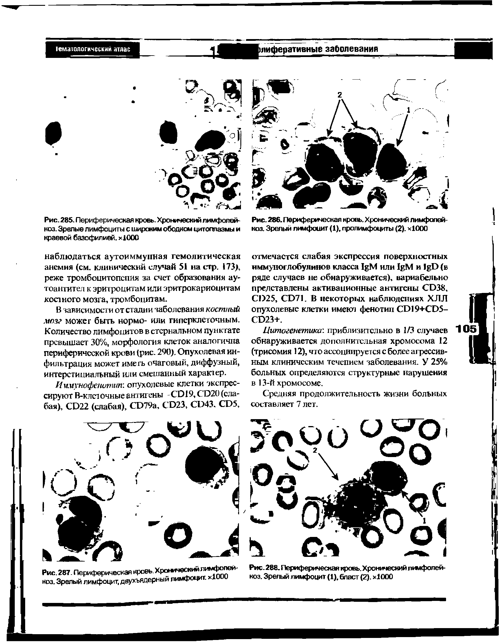 Рис.286. Периферическая кровь. Хронический лимфолей-коз. Зрелый лимфоцит (1). пролимфоциты (2). OOO...