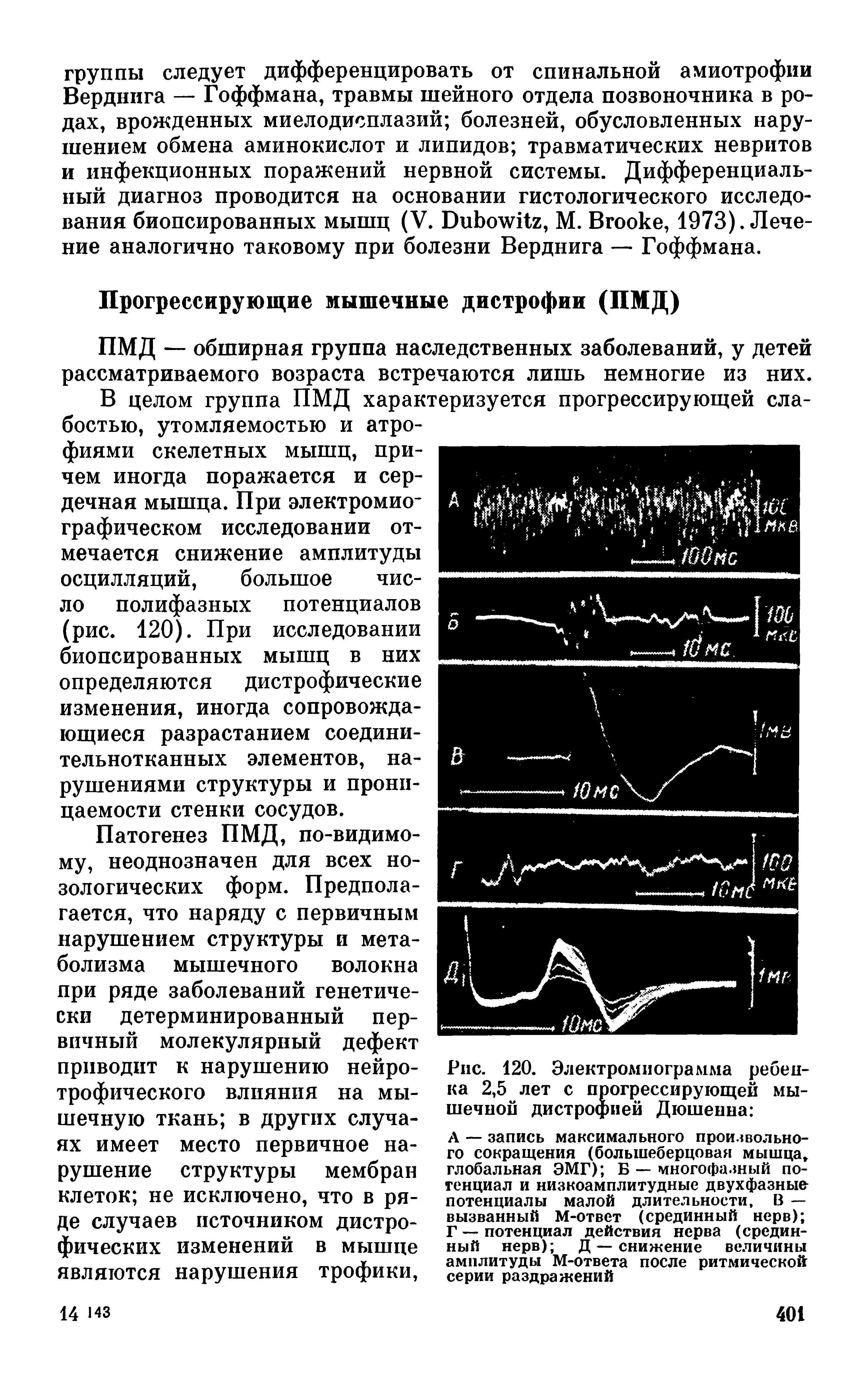 Рис. 120. Электромиограмма ребенка 2,5 лет с прогрессирующей мышечной дистрофией Дюшенна ...