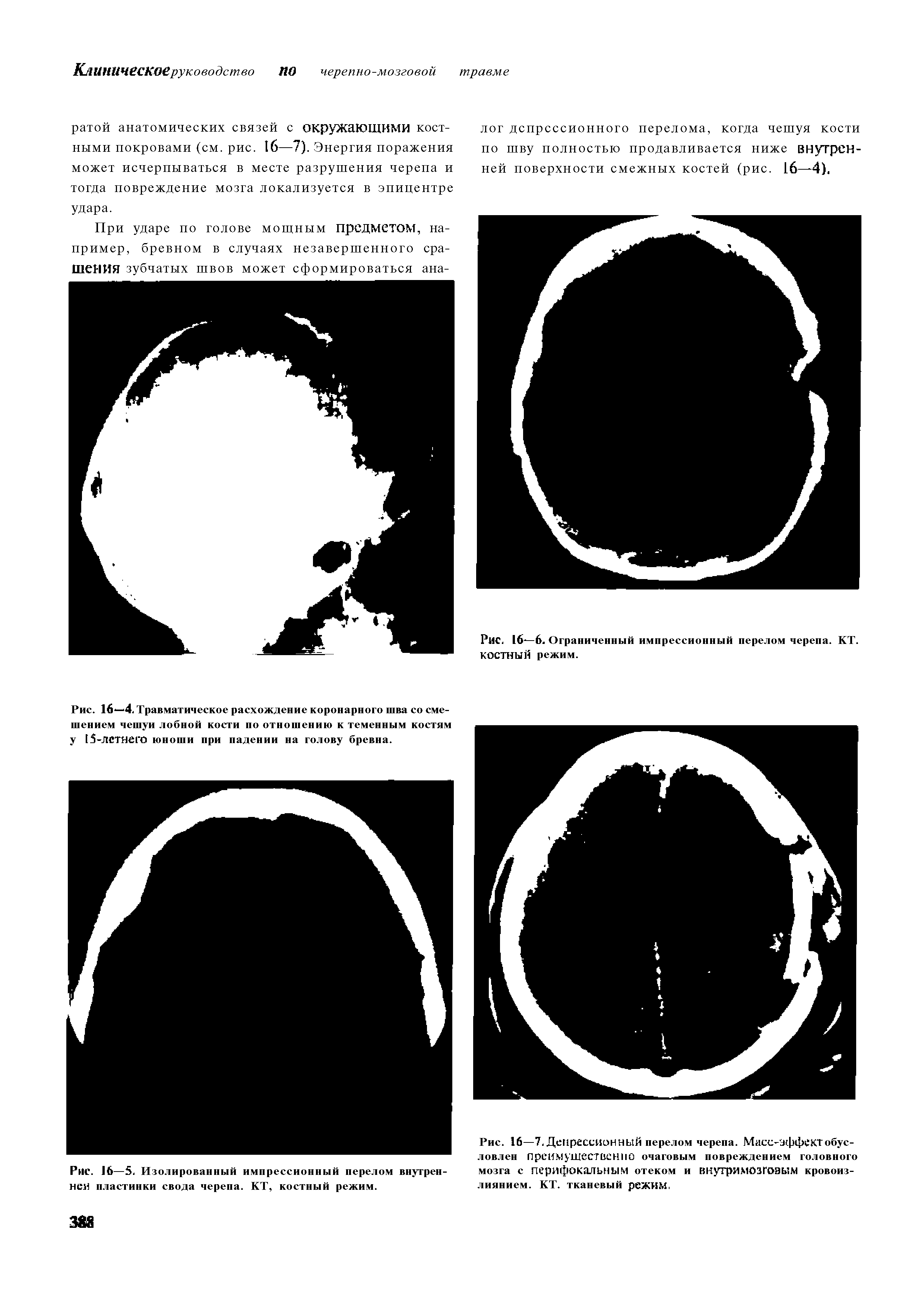 Рис. 16—6. Ограниченный импрессионный перелом черепа. КТ. КОСТНЫЙ режим.