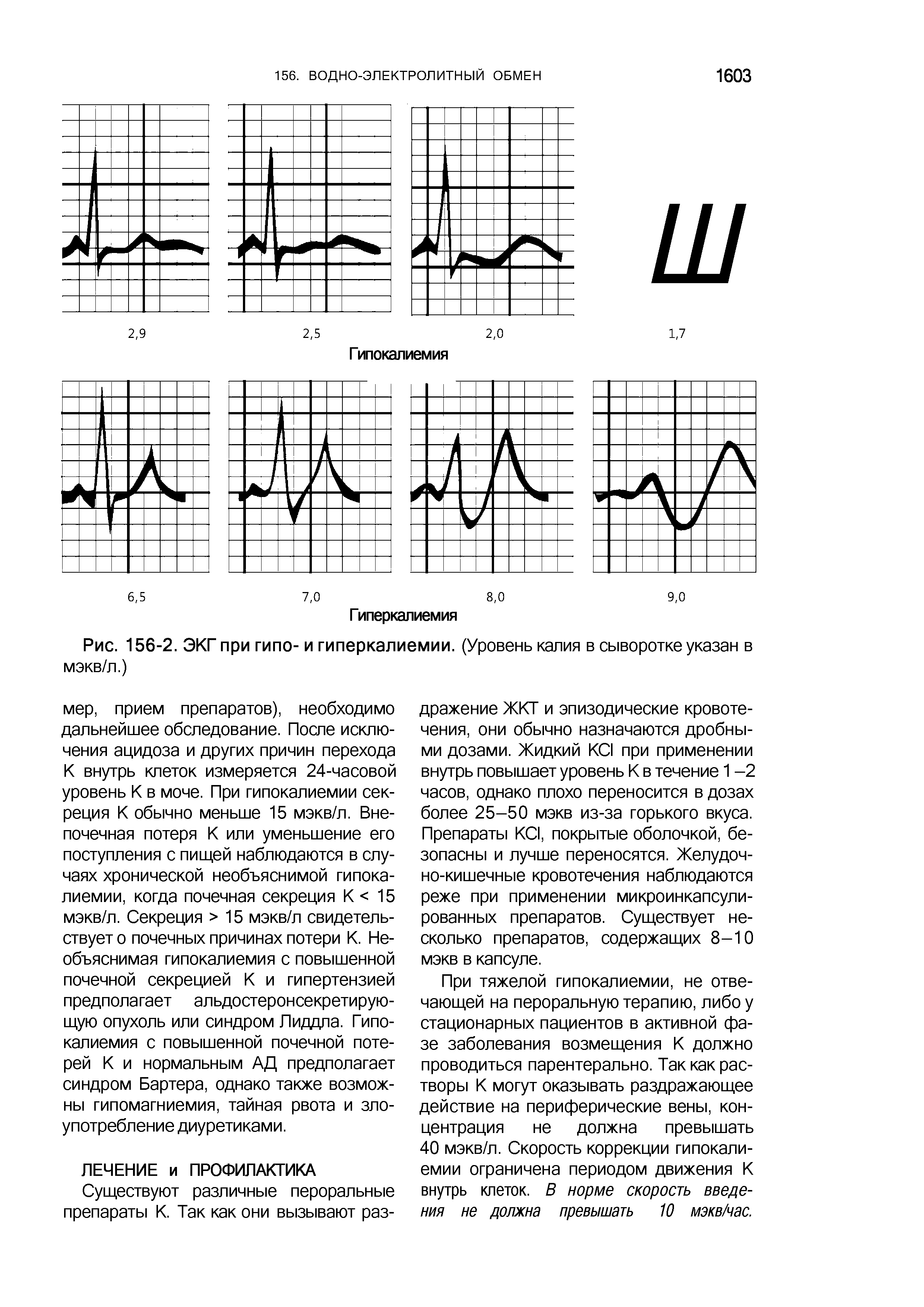 Рис. 156-2. ЭКГ при гипо- и гиперкалиемии. (Уровень калия в сыворотке указан в мэкв/л.)...