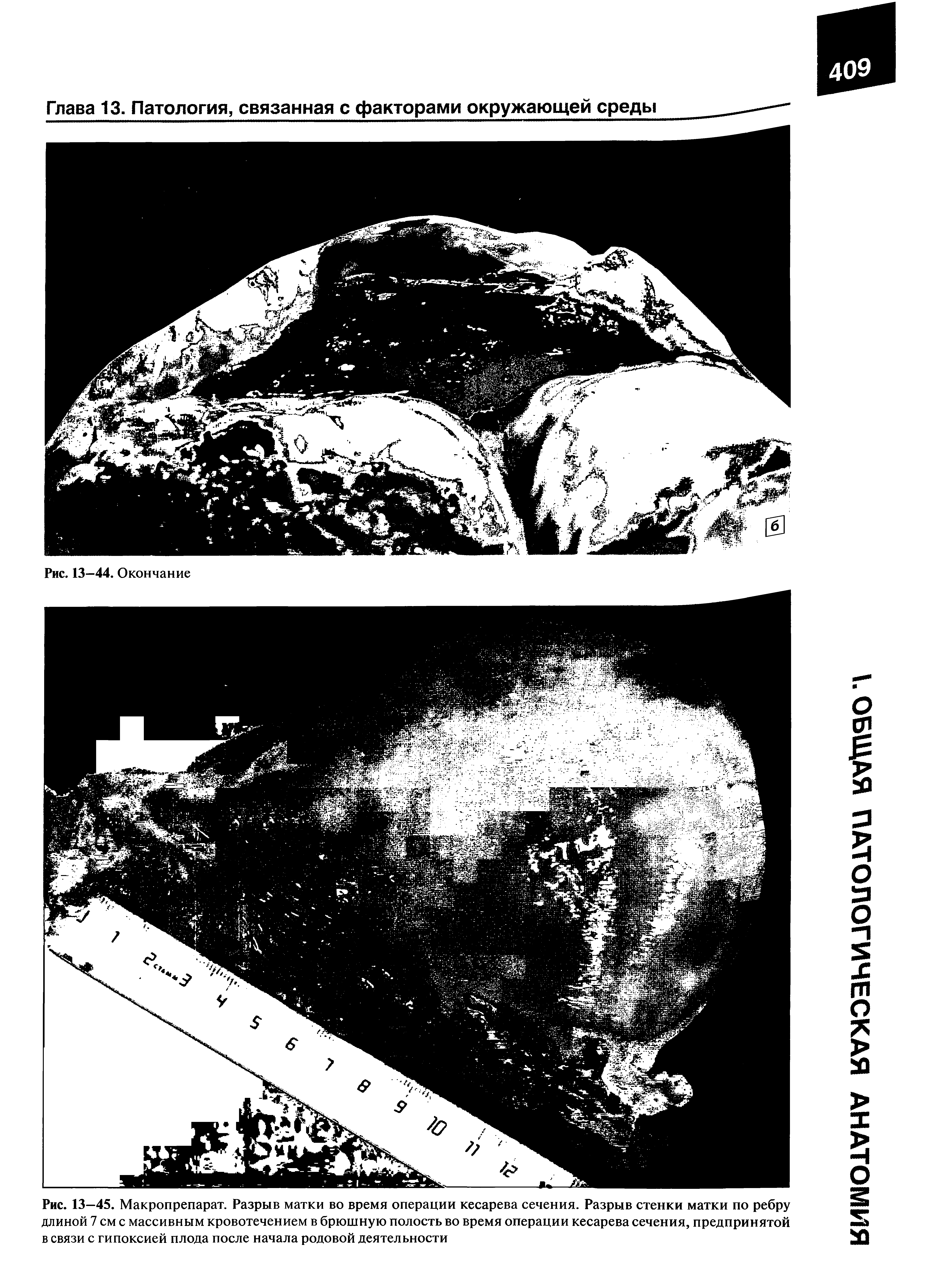 Рис. 13—45. Макропрепарат. Разрыв матки во время операции кесарева сечения. Разрыв стенки матки по ребру длиной 7 см с массивным кровотечением в брюшную полость во время операции кесарева сечения, предпринятой в связи с гипоксией плода после начала родовой деятельности...