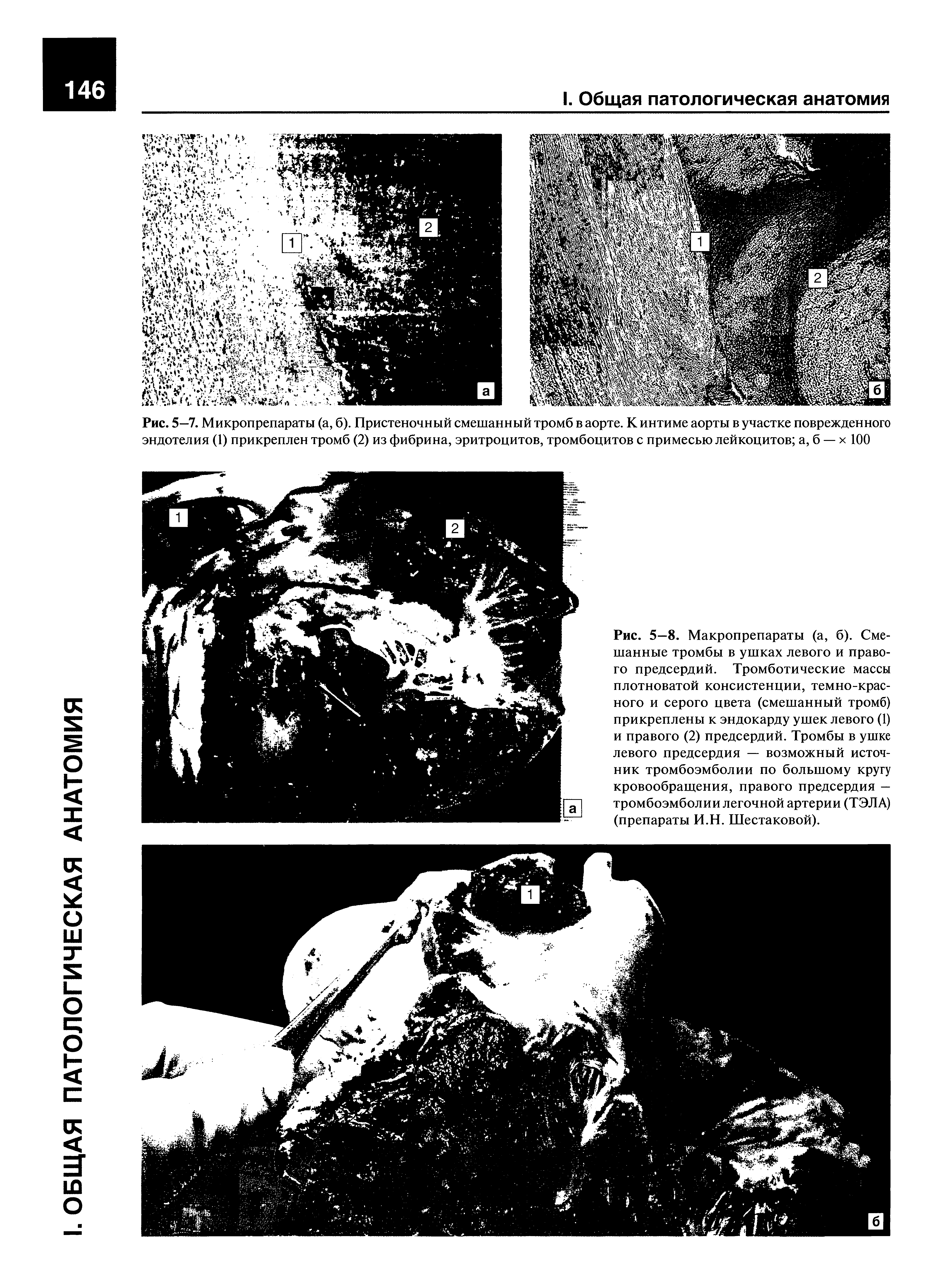 Рис. 5—7. Микропрепараты (а, б). Пристеночный смешанный тромб в аорте. К интиме аорты в участке поврежденного эндотелия (1) прикреплен тромб (2) из фибрина, эритроцитов, тромбоцитов с примесью лейкоцитов а, б — х 100...